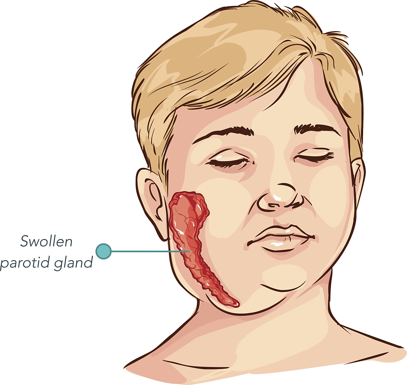 流行性腮腺炎是一种由腮腺病毒引起的传染病.