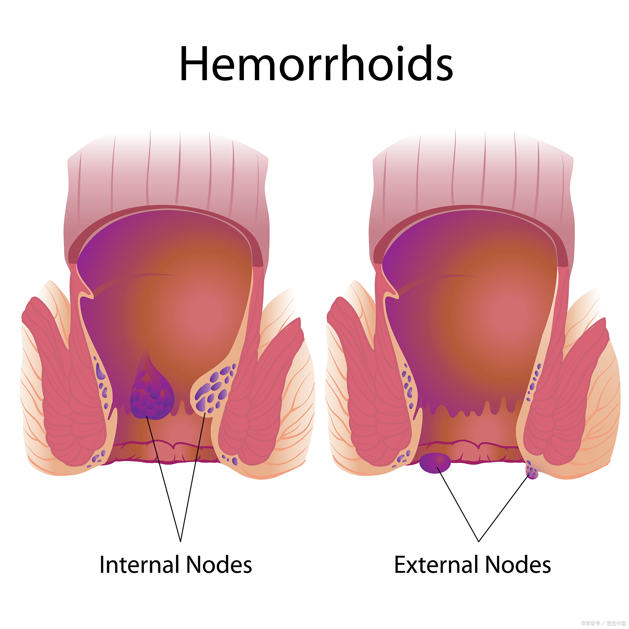 几种常见的痔疮图片图片