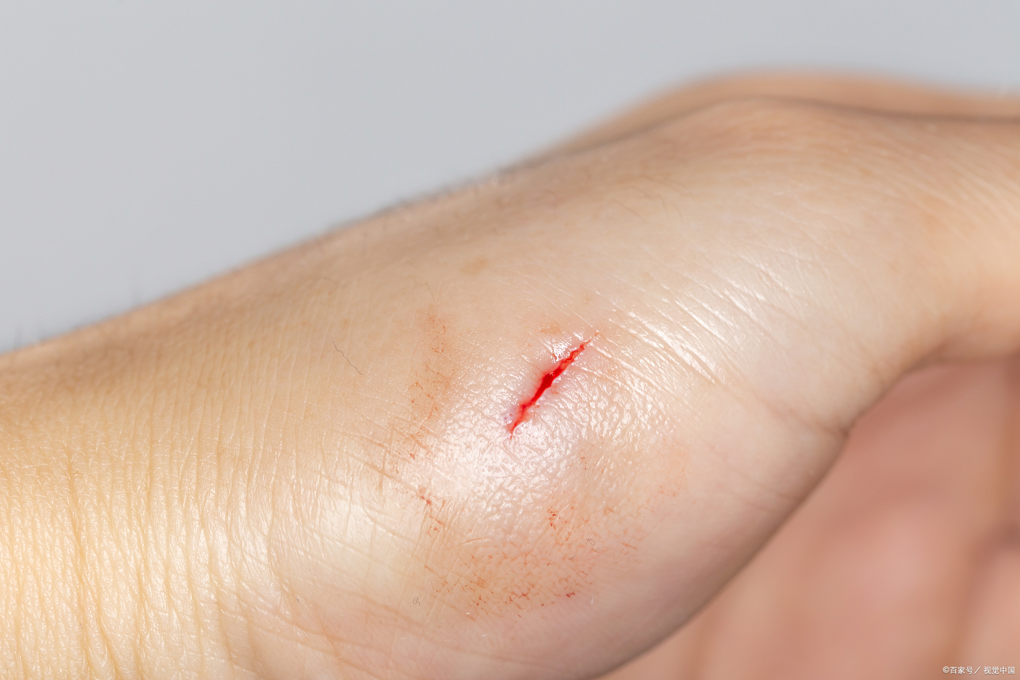 被老鼠咬了需要打疫苗吗