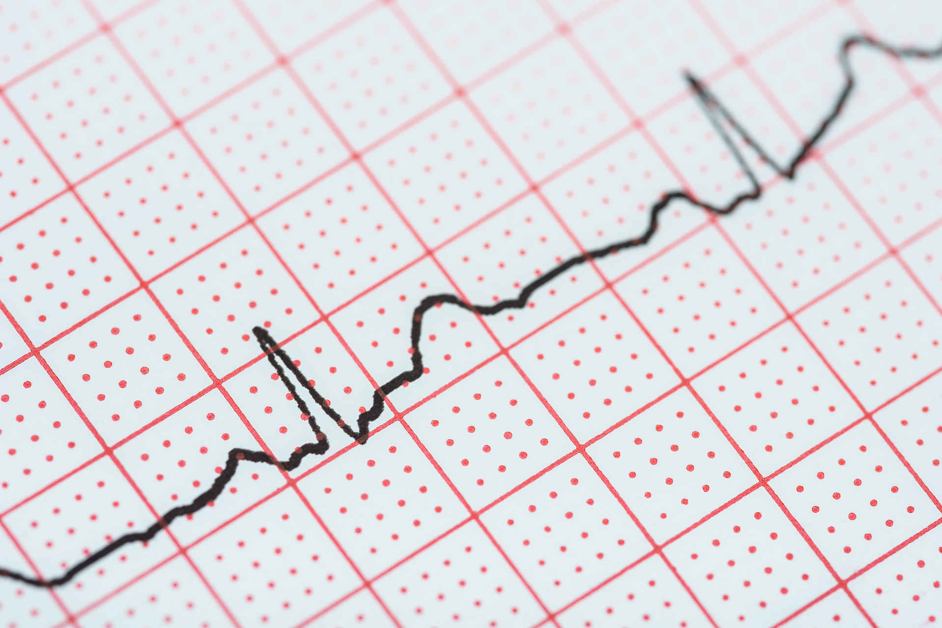 不少患者看到心电图上的报告"窦性心律不齐"时,误以为自己有了心脏 