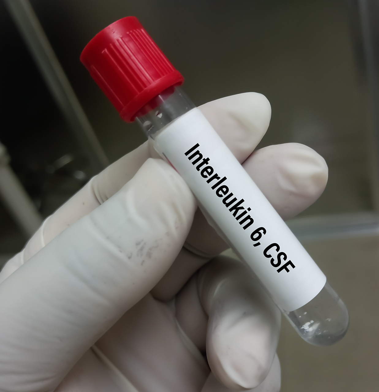 脑脊液检查什么病?  脑脊液常规临床上是最常用的一种检查,临床上如果