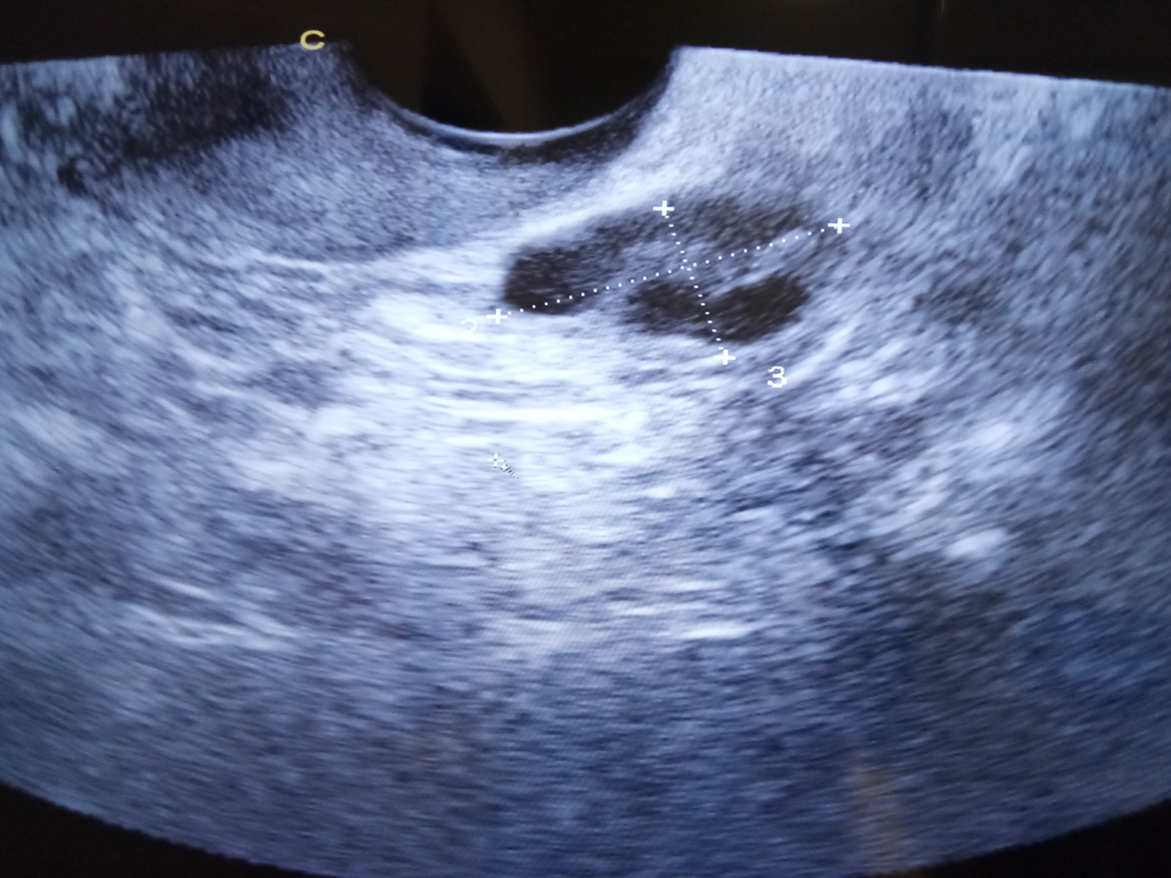 哪些女性有必要做卵泡监测? 1,月经不规律的女性:如月经失调,无排卵性