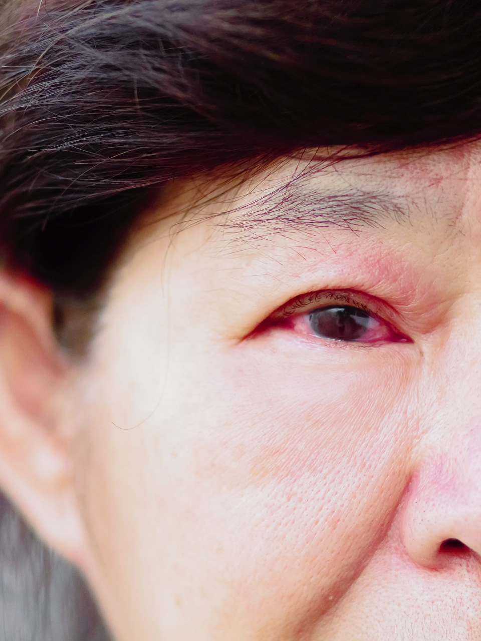 肿眼泡# #眼睛肿了#   1.冷敷:  可以用冷毛巾敷眼皮,帮助减轻肿胀.