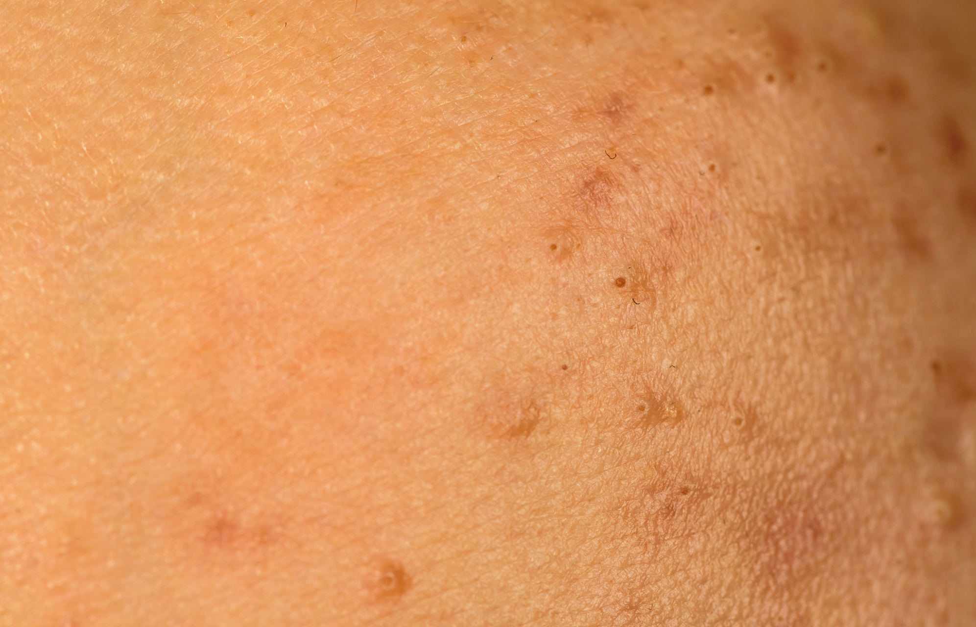 1,淋病:淋病常表现为泌尿生殖系统的化脓性感染,女性多为宫颈炎,男性