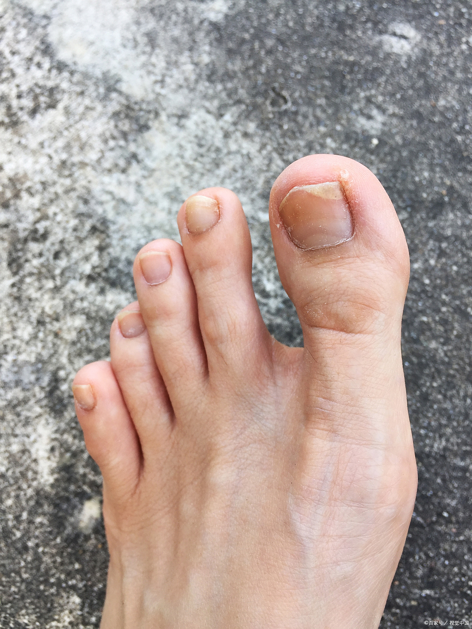 神经根受压或炎症刺激,引发下肢疼痛,麻木,无力,甚至大脚趾周围的麻木