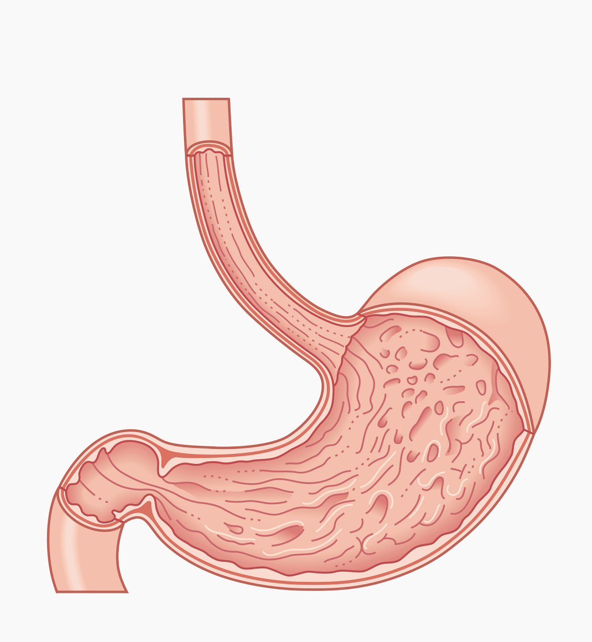 反流性食管炎,7天养胃食谱,不反酸烧心 反流性食管炎是由十二指肠,胃