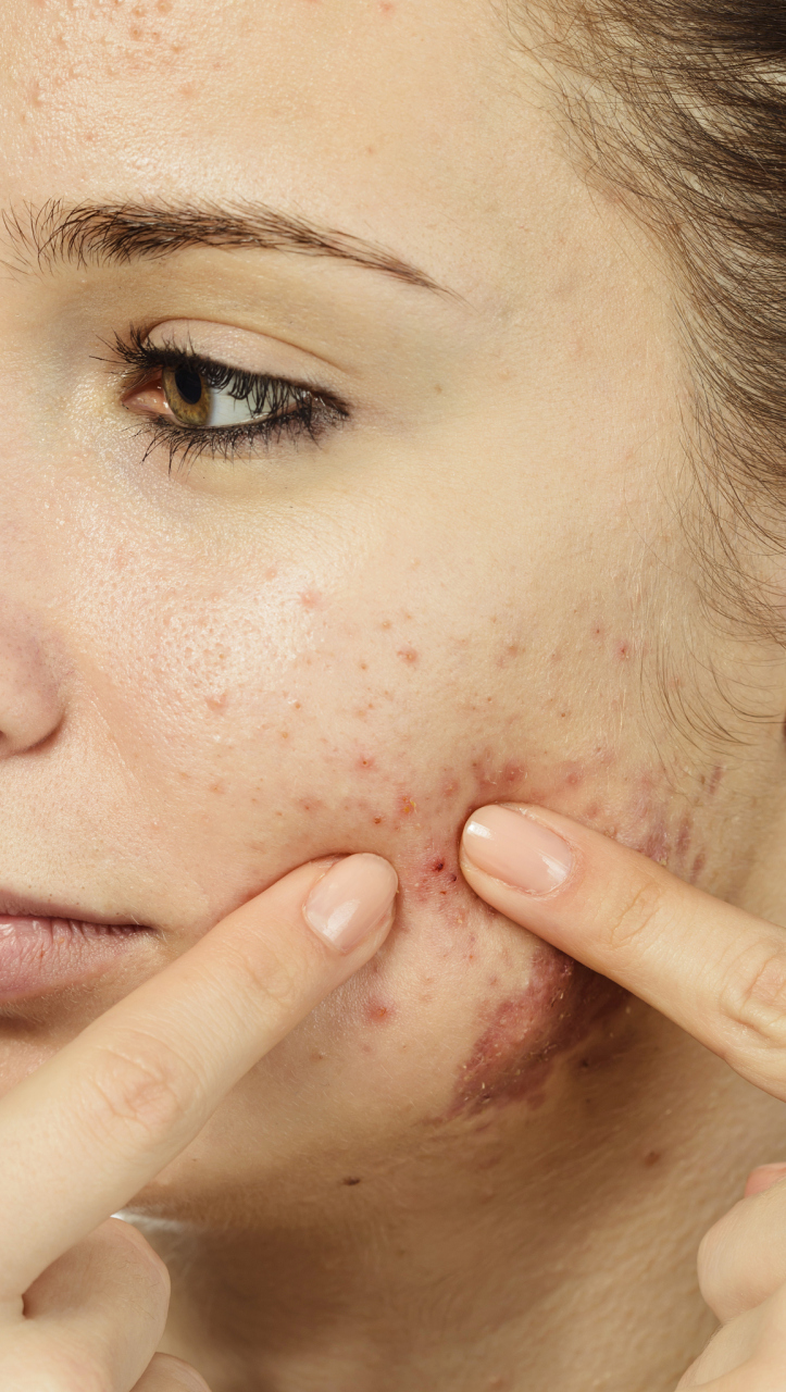 下巴两侧腮帮子长痘痘怎么办?