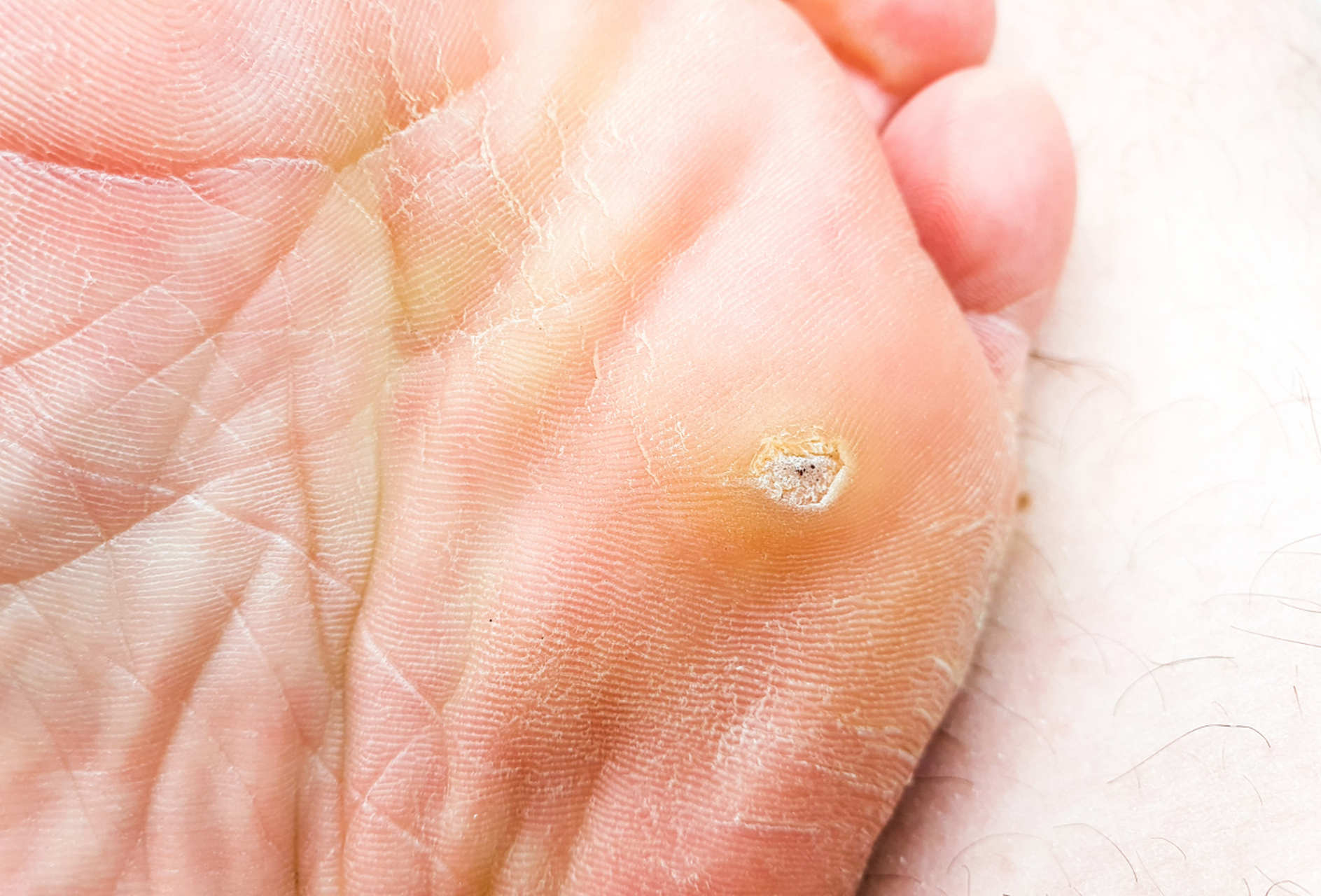 【小脚趾长了鸡眼很痛该怎么处理?】可以采取以下措施进行处理:  1.