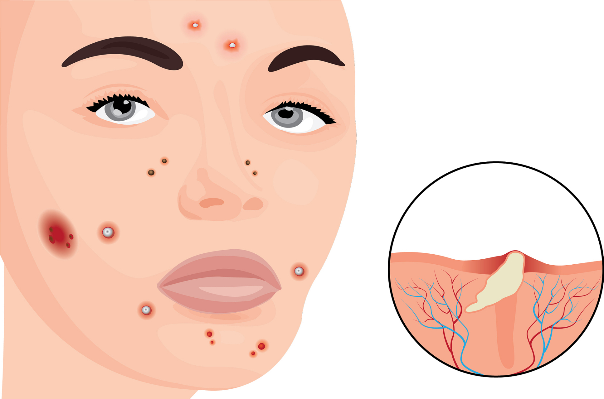 油皮痘痘肌怎么改善  油皮痘痘肌是许多人都面临的问题,特别是在炎热