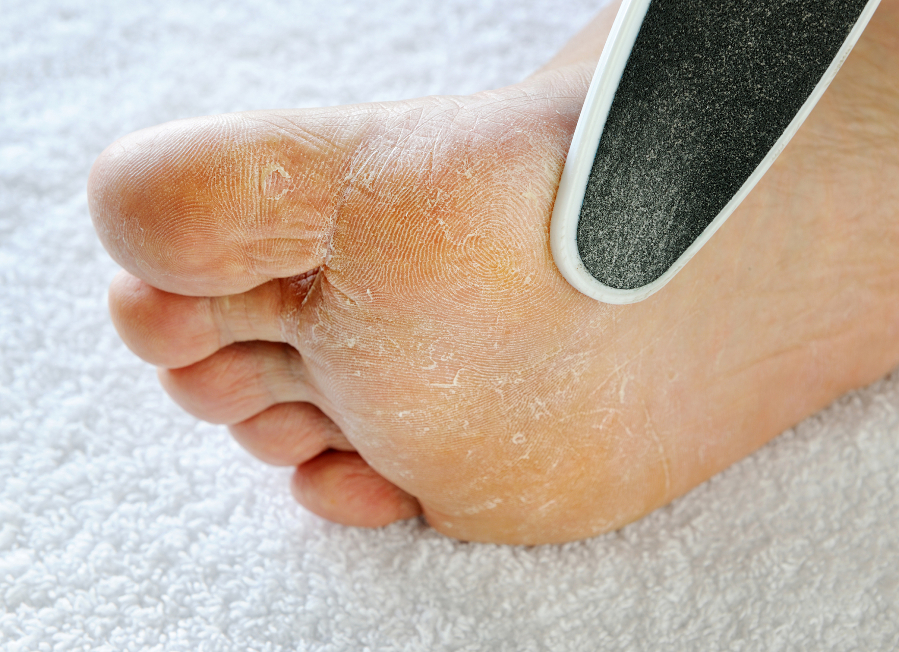 避免脚气感染,还得从以下4个方面入手  脚气是真菌感染引起的,如果没