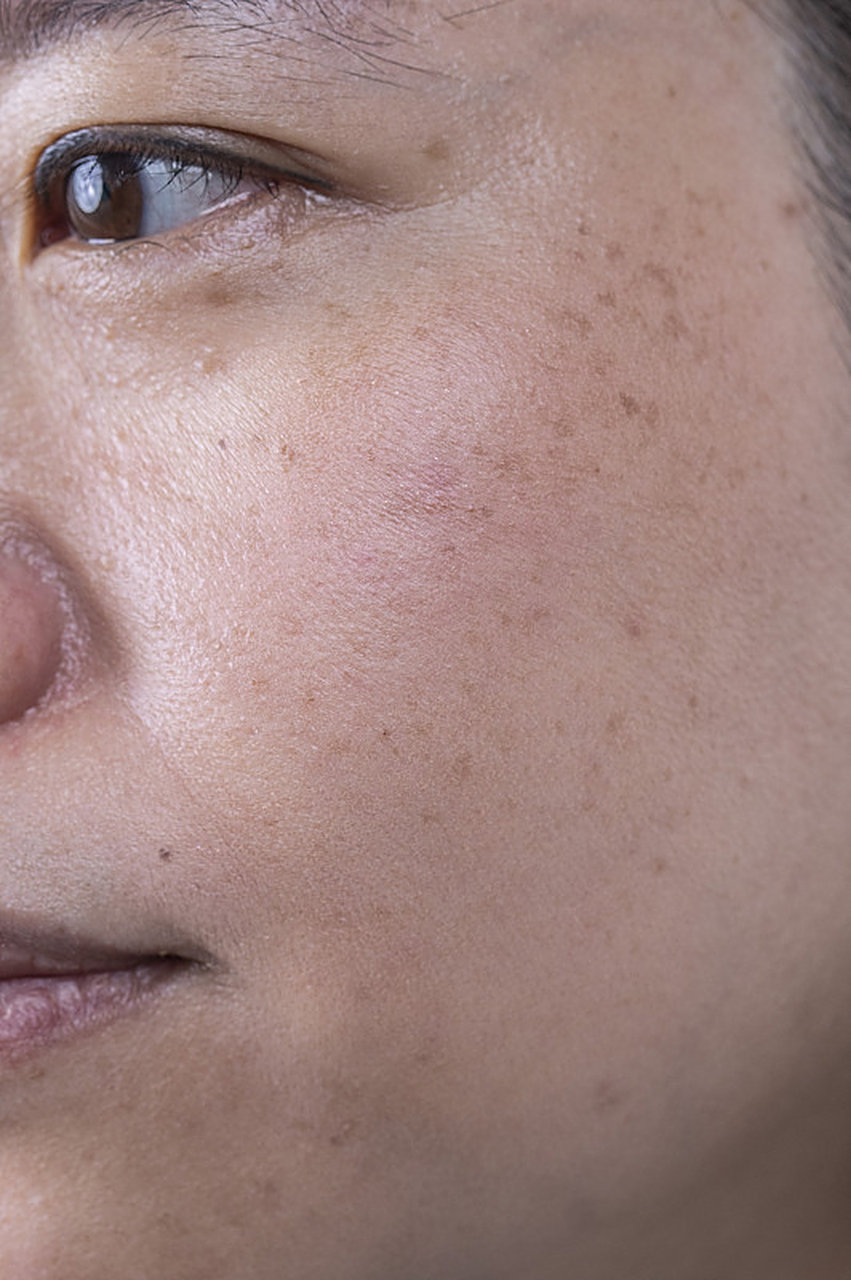 血瘀在脸,就会形成斑,太冲穴帮你忙!