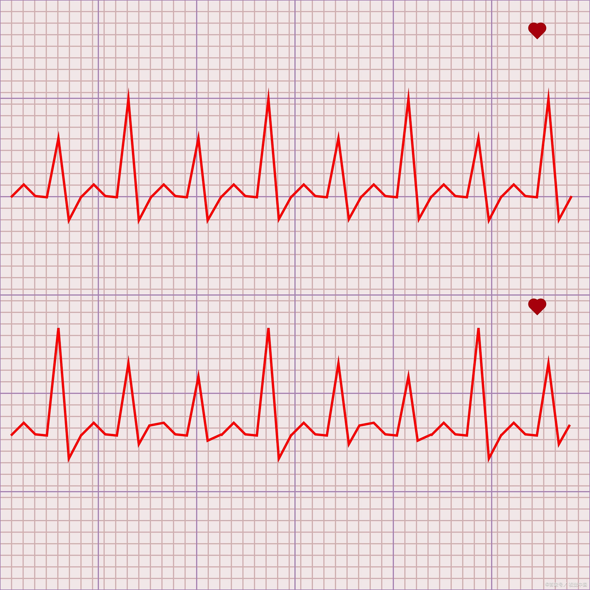 进而引起的心跳加速和心律不齐,一般心律失常心电图心电图健康的心电