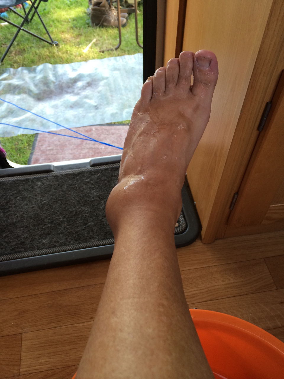 五种方法助你快速恢复  👣脚踝扭伤是日常生活中常见的意外,尤其是