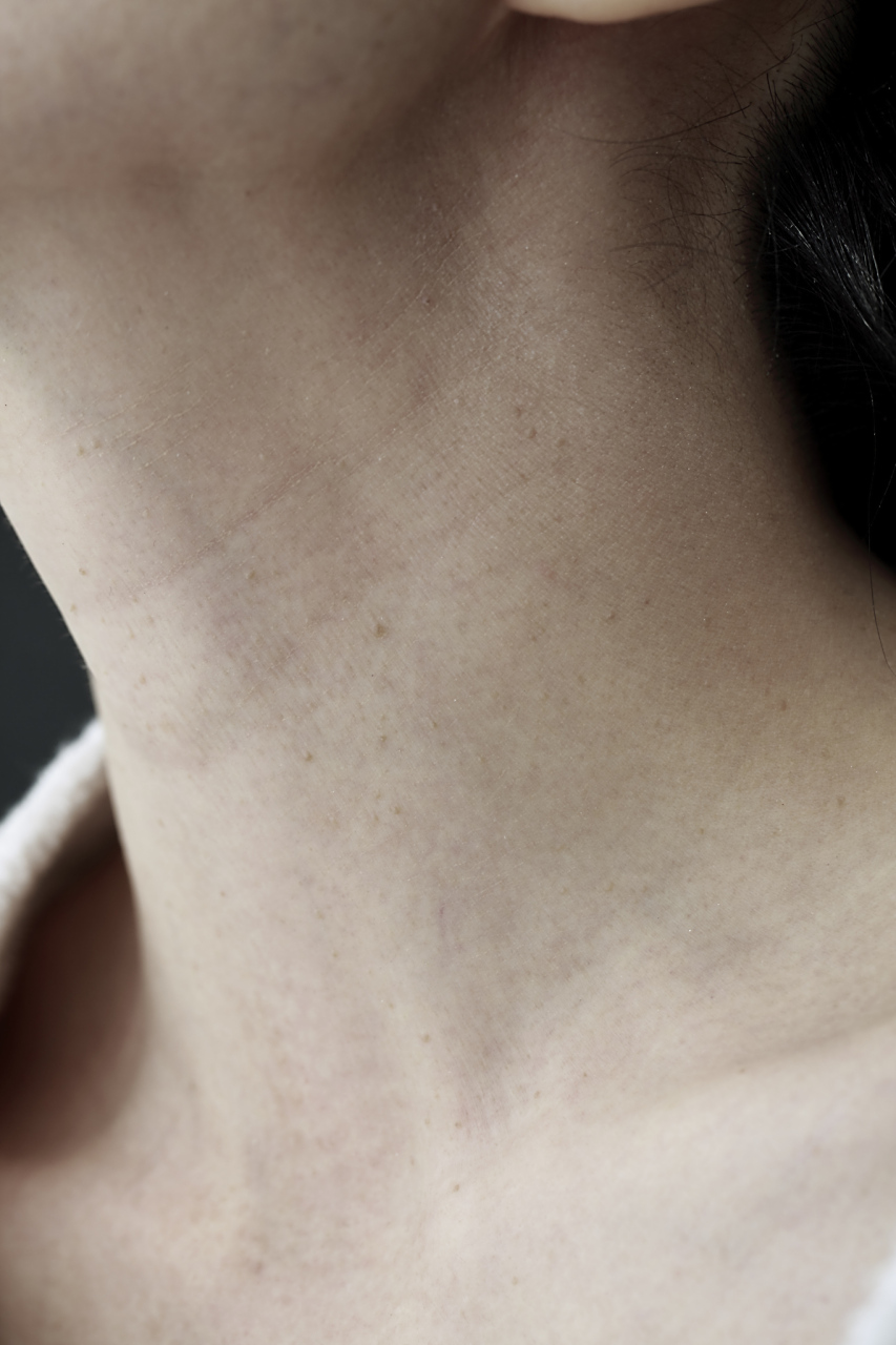 那就是脖子黑素沉淀,让人看起来像是没洗干净一样