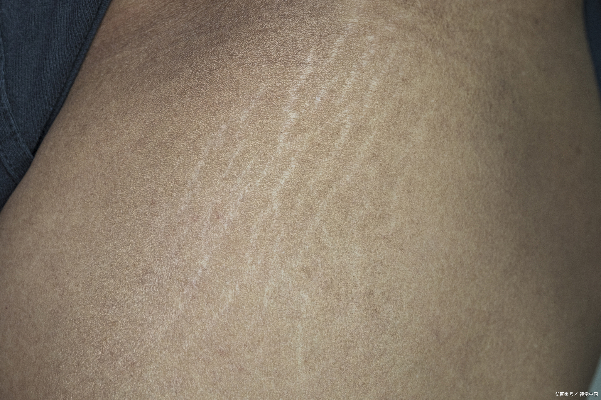 妊娠纹是孕妈妈们在孕期常见的问题之一,它们通常出现在腹部,臀部