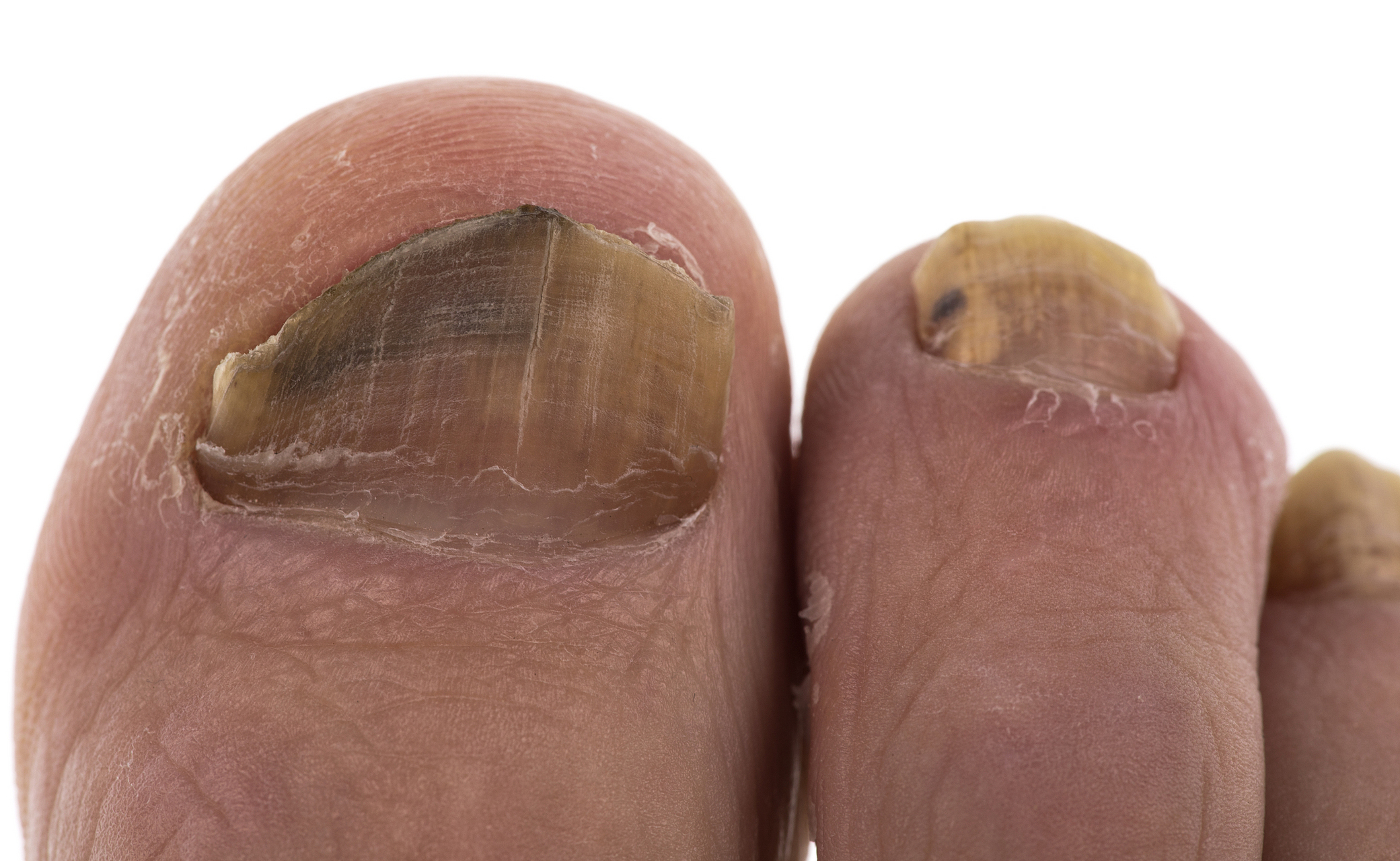 做以下检查,能够看出是否得了甲癣!#皮肤管理课堂# #甲癣#   一般做真