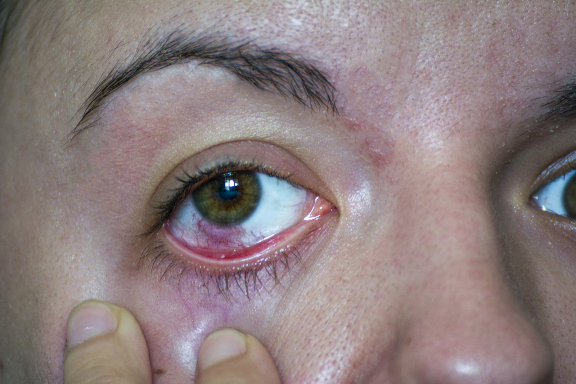 预防眼部感染和结膜炎的方法有以下几点:  1