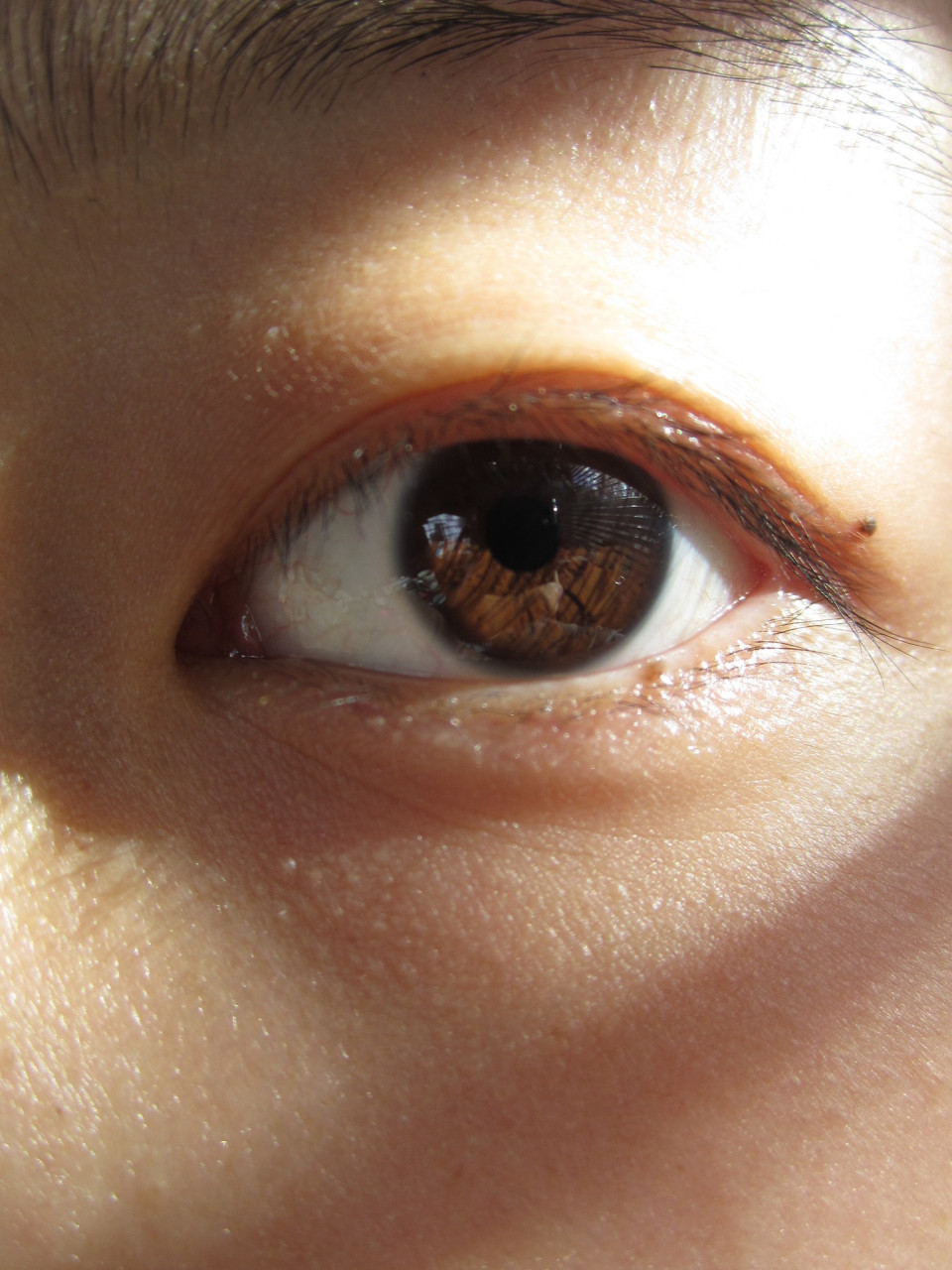 肿眼泡 #悦己爱眼季#  #眼部综合#   肿眼泡是指眼睑下部的组织膨胀