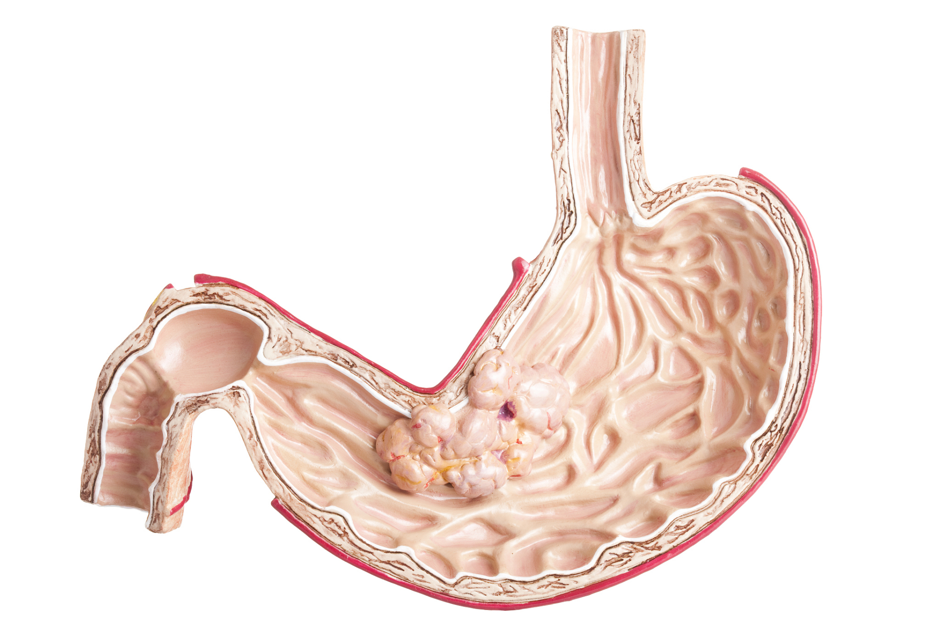 我被查出胃癌,老婆不愿来医院照顾我,直言要与我离婚  不久前,我被
