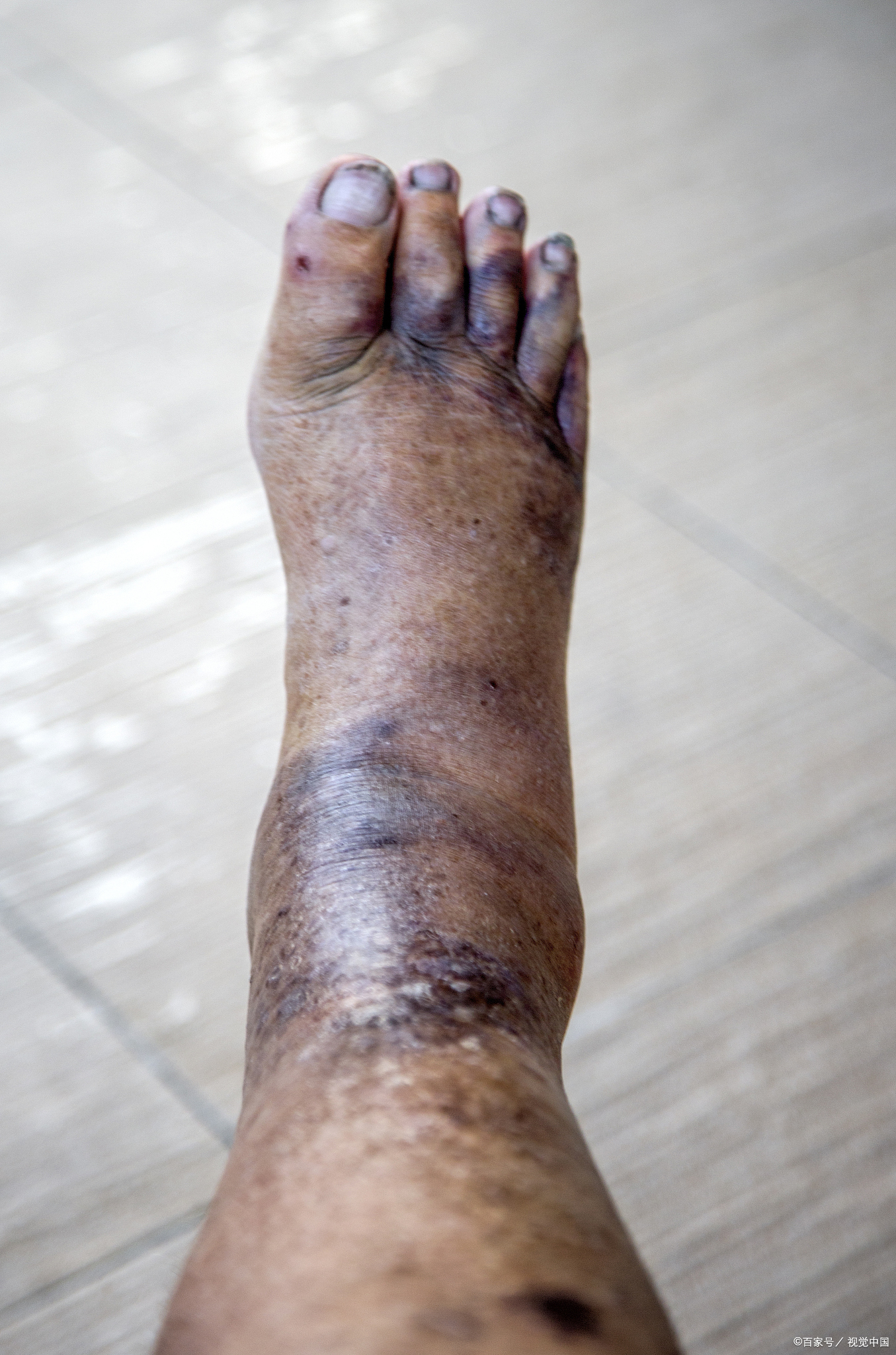 糖尿病足溃烂严重影响患者生活质量,以下方法有助于快速愈合