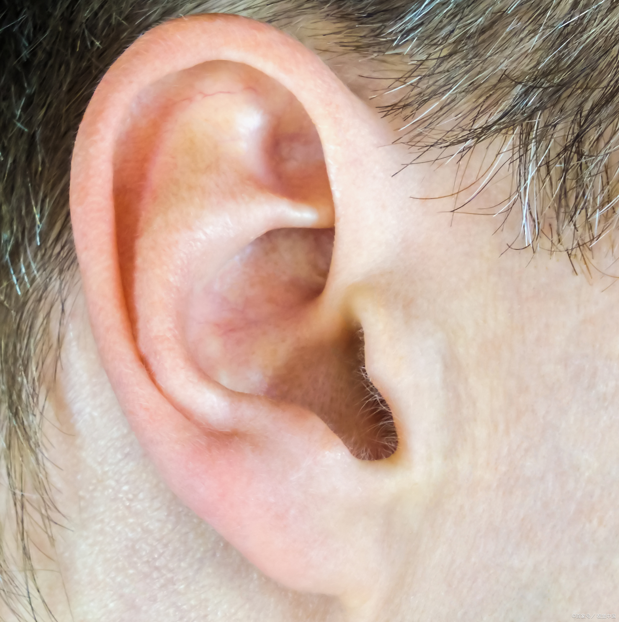 [疑问]  耳廓假性囊肿,这一医学术语听起来或许有些陌生,但它却是一种