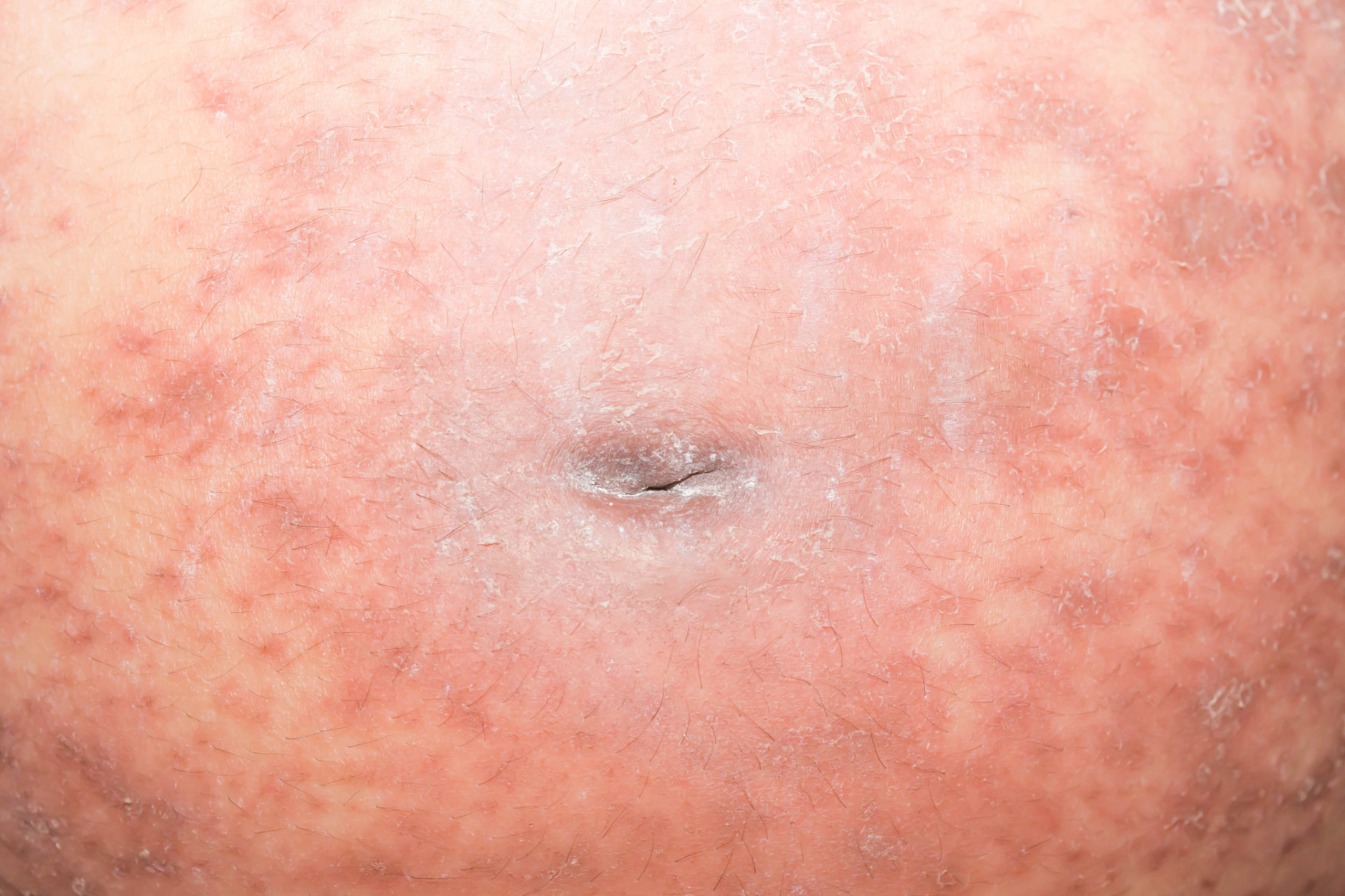 【肚皮痒,挠了以后也不管用,以前也没有过敏过,还可能是什么原因?