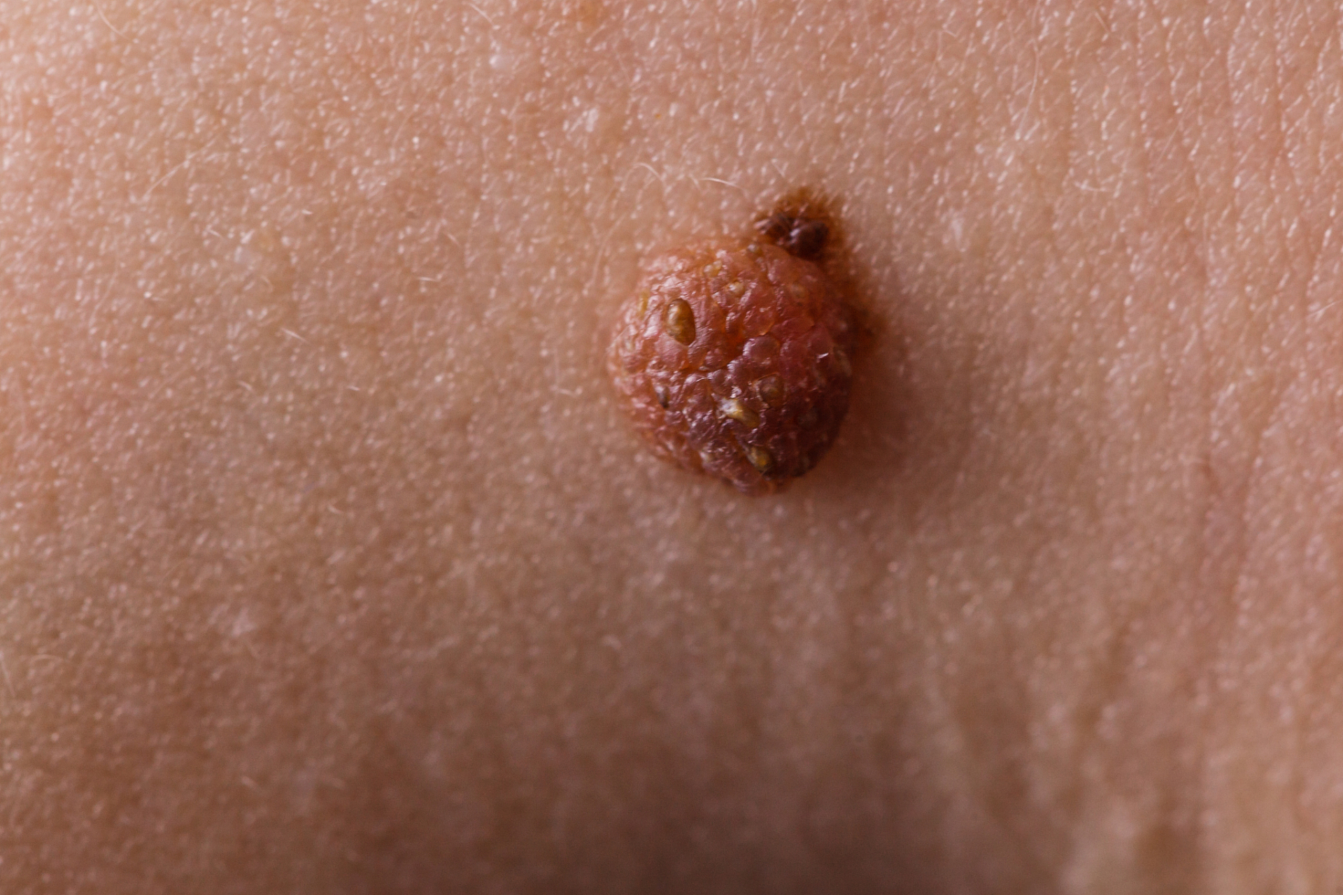 中医老郭说肛肠 常识篇3(下) 肛门口的"肉疙瘩"要重视 肛门口一旦出现