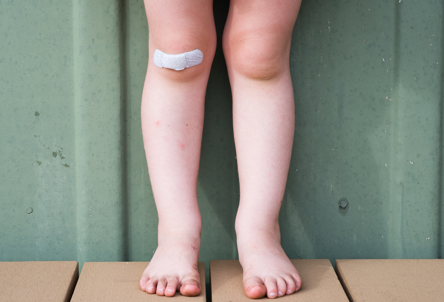 幼儿没有膝跳反射会是#脑瘫# 吗?