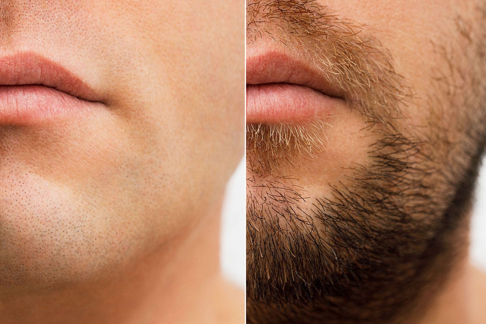 男生脸上汗毛多要想永久去除,可以选择光子嫩肤技术,以及半导体