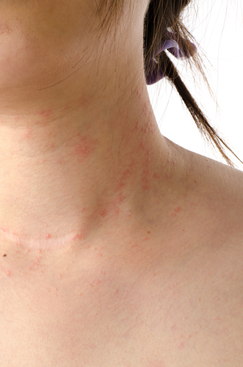 红蓝光祛痘:解决脖子痘痘的有效方法  脖子上的痘痘是令人困扰的问题