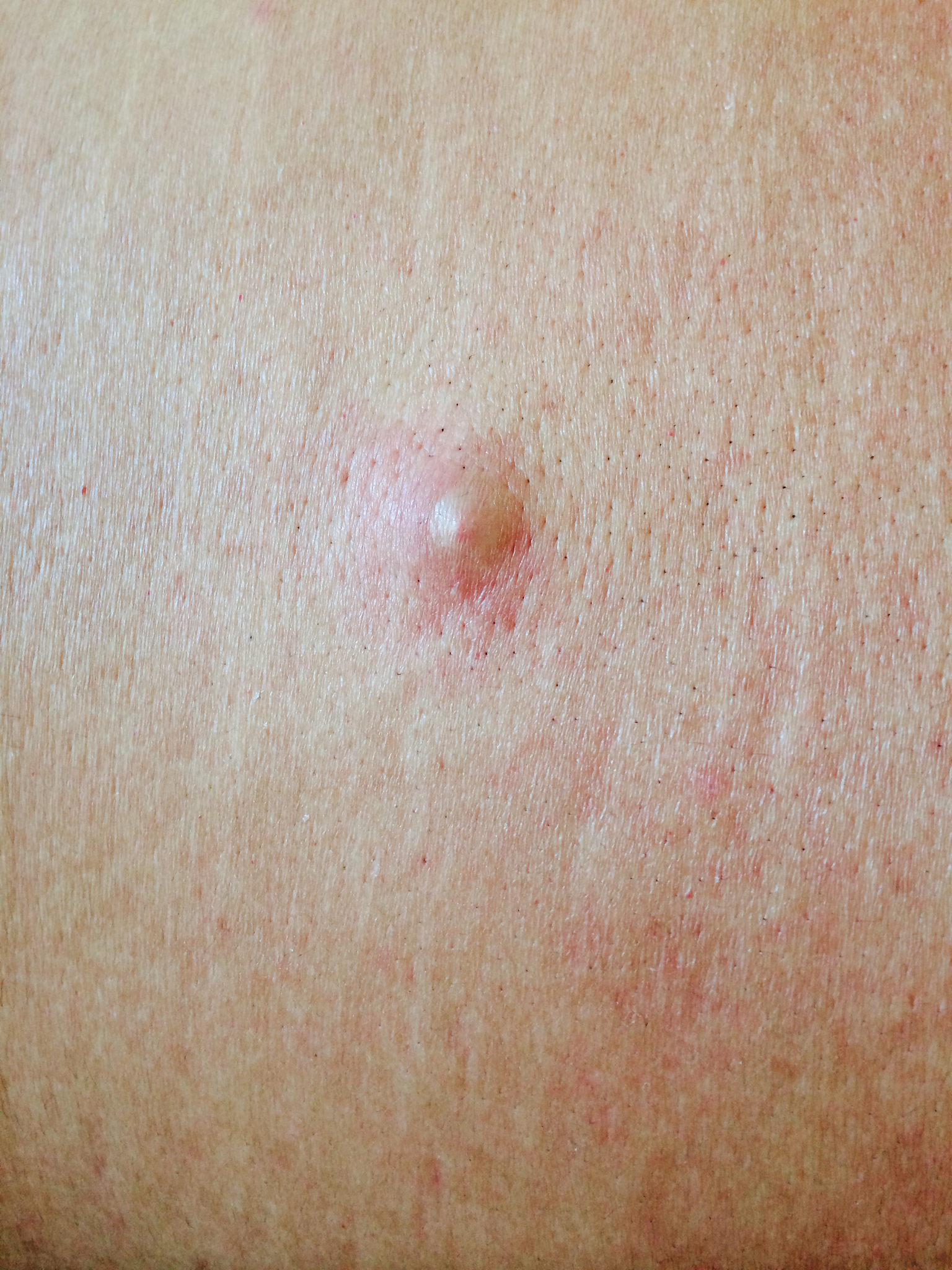 上长了个头疖子,没想到越来越大,自己在家不敢处理,后来流脓又发炎了