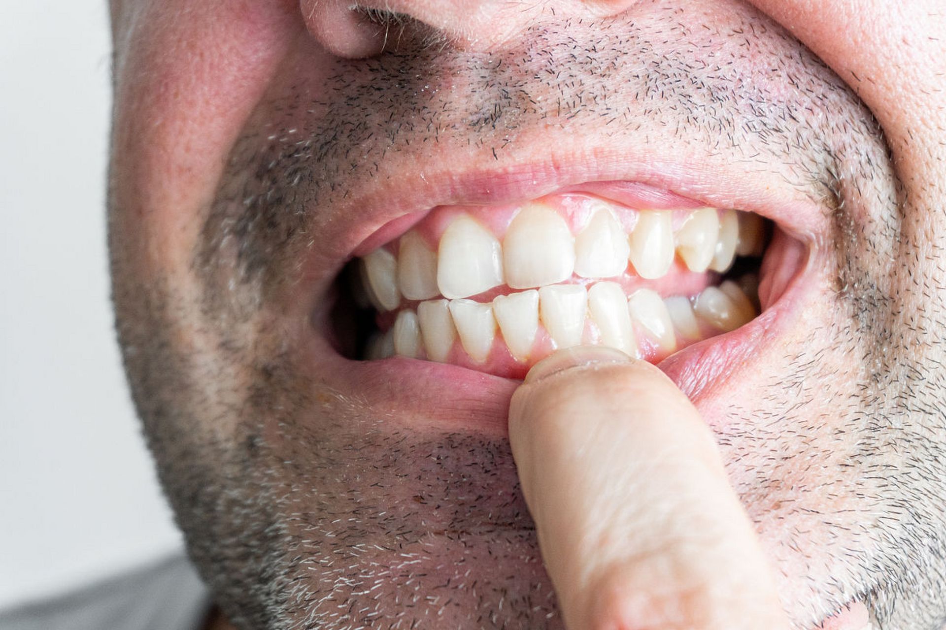 牙齿两侧的口腔内壁有凸起是怎么回事?需要干预吗?