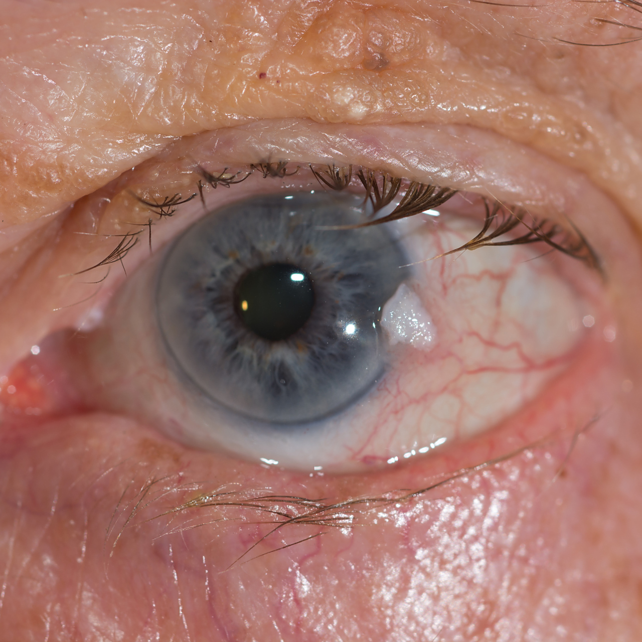 这是因为糖尿病可能导致视网膜病变等眼部并发症,严重影响视力甚至