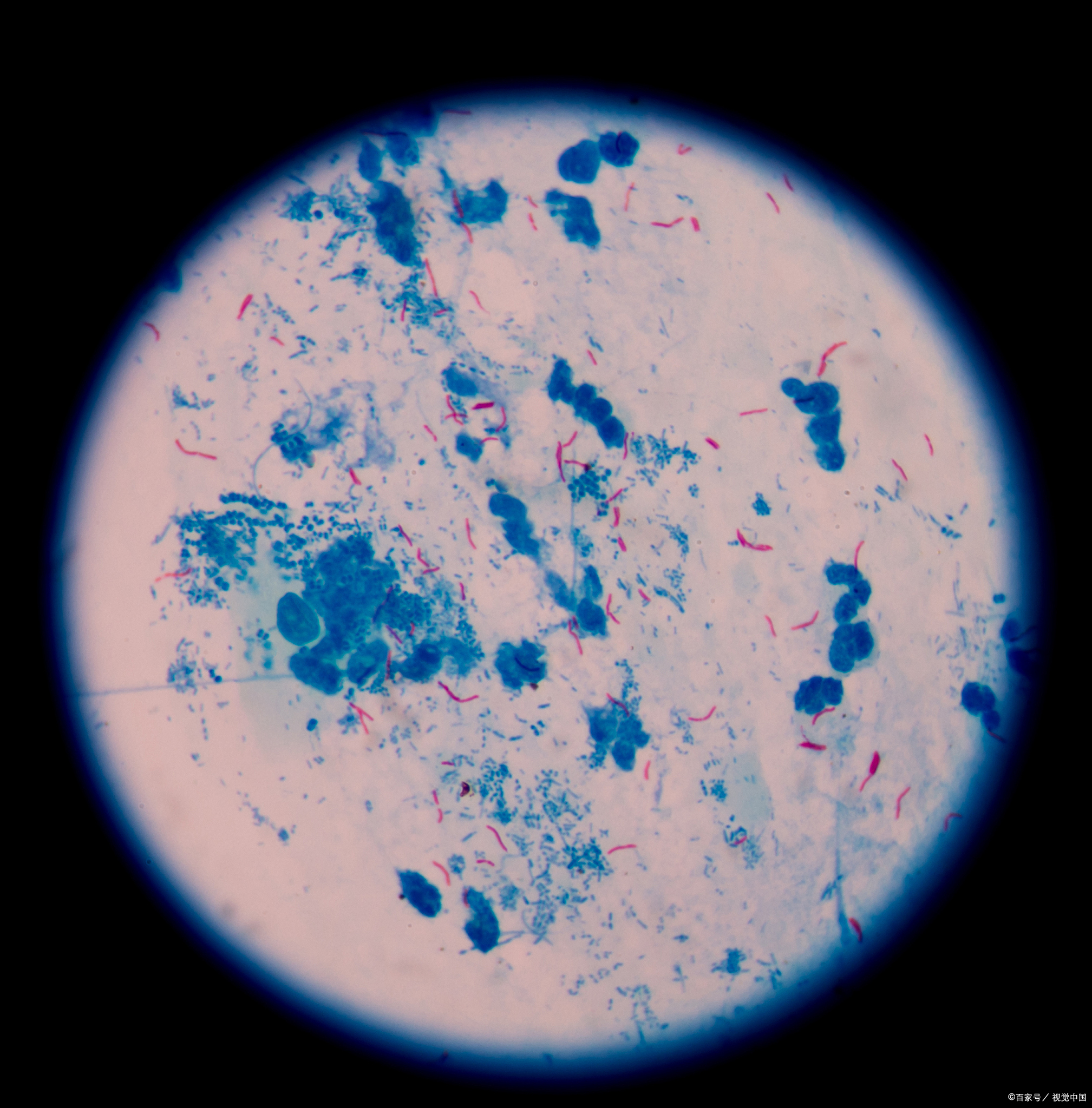 胃炎常见症状多样