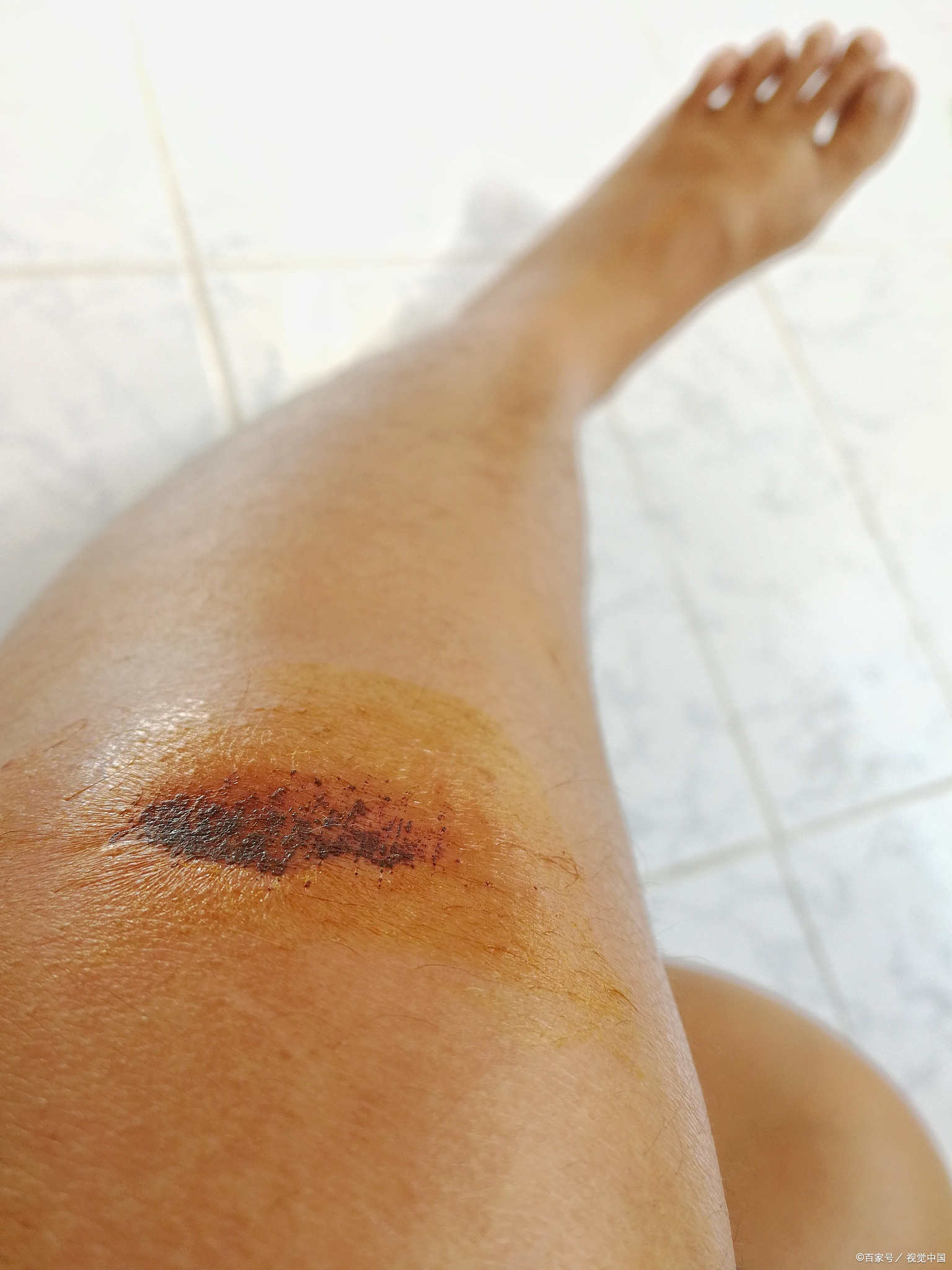 科学处理,助你快速恢复!