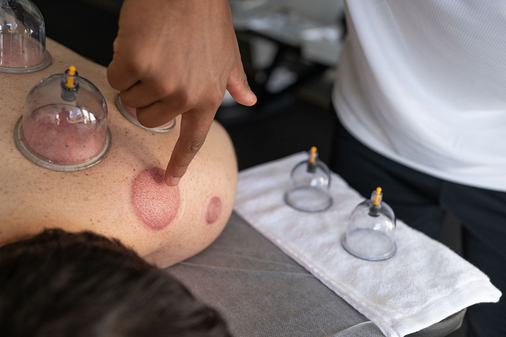 很多人在拔火罐之后会发现皮肤上出现了一些瘀斑,于是有人就产生了