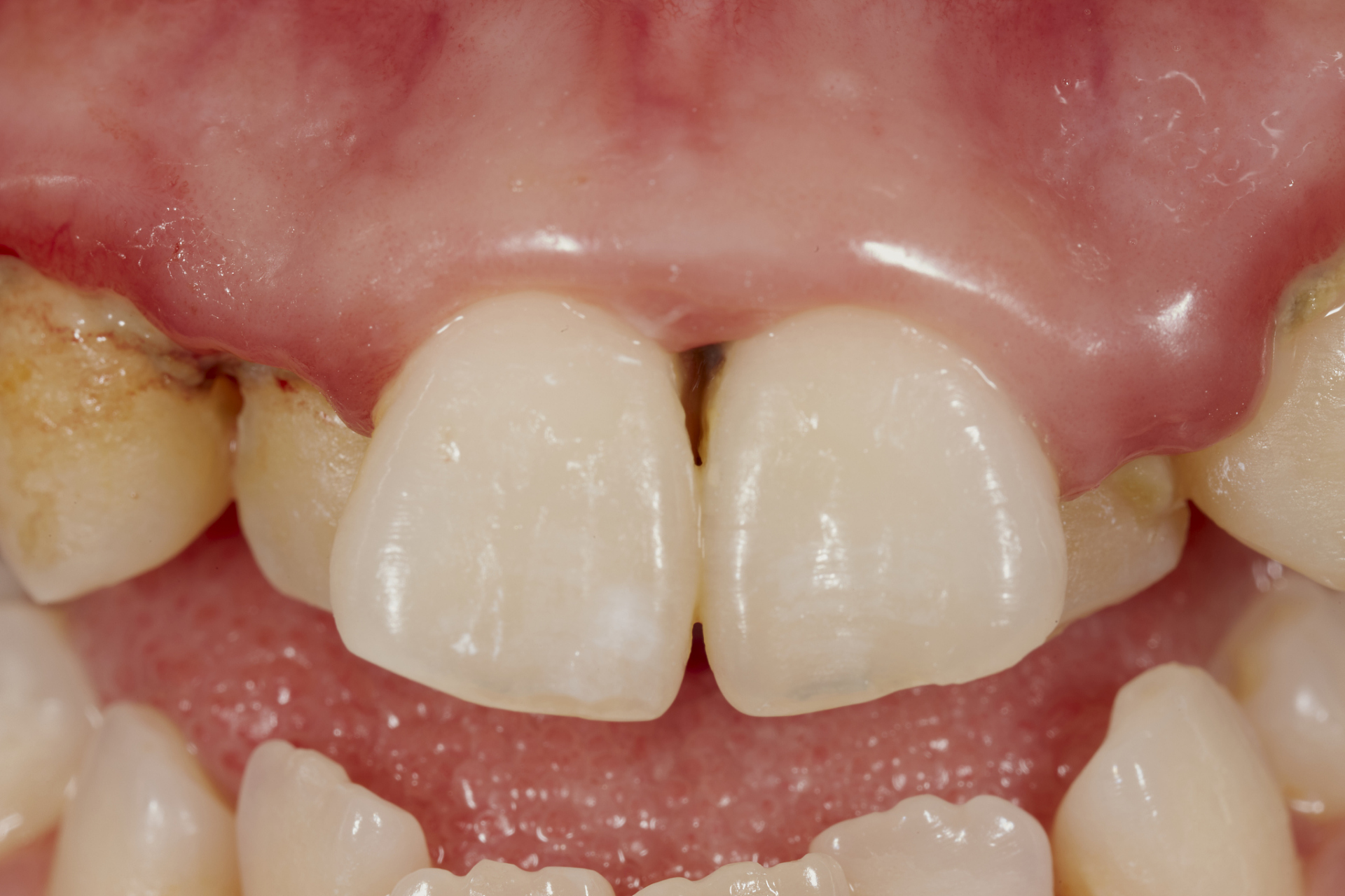 儿童牙齿钙化图片