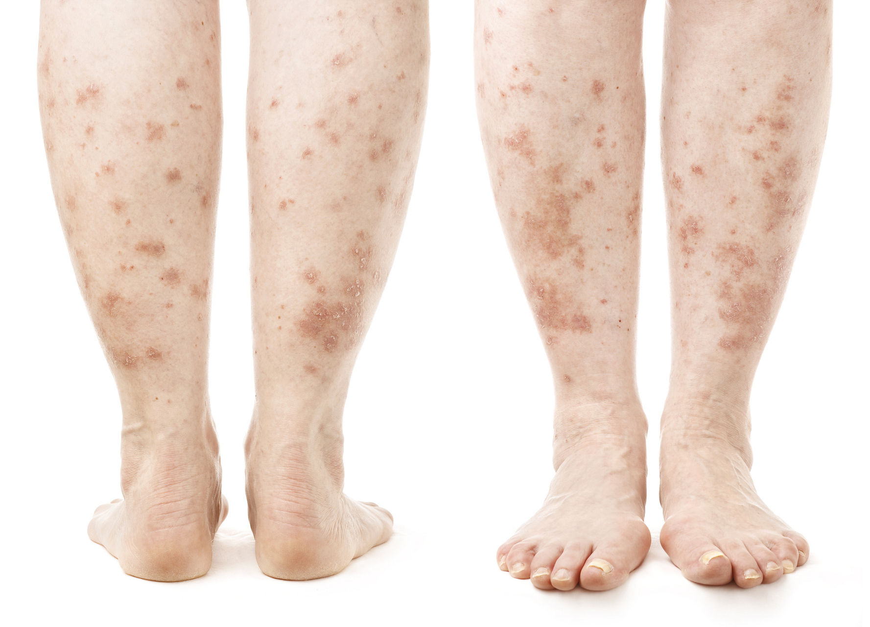 湿疹早期症状揭秘:如何辨识并及早防范皮肤问题?