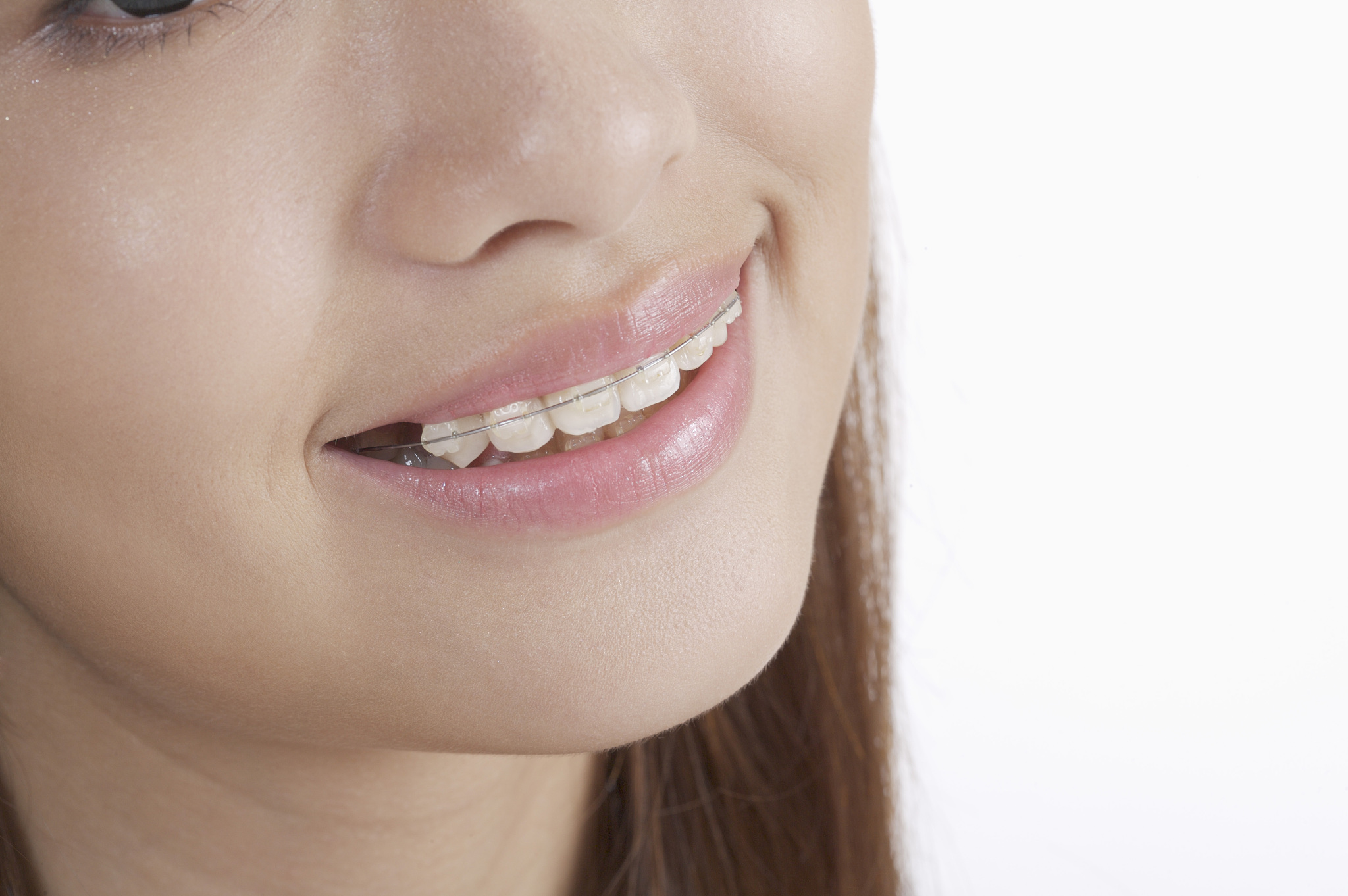 经过一段时间的牙齿矫正治疗,终于拥有了整齐美观的牙齿,但这并不意味