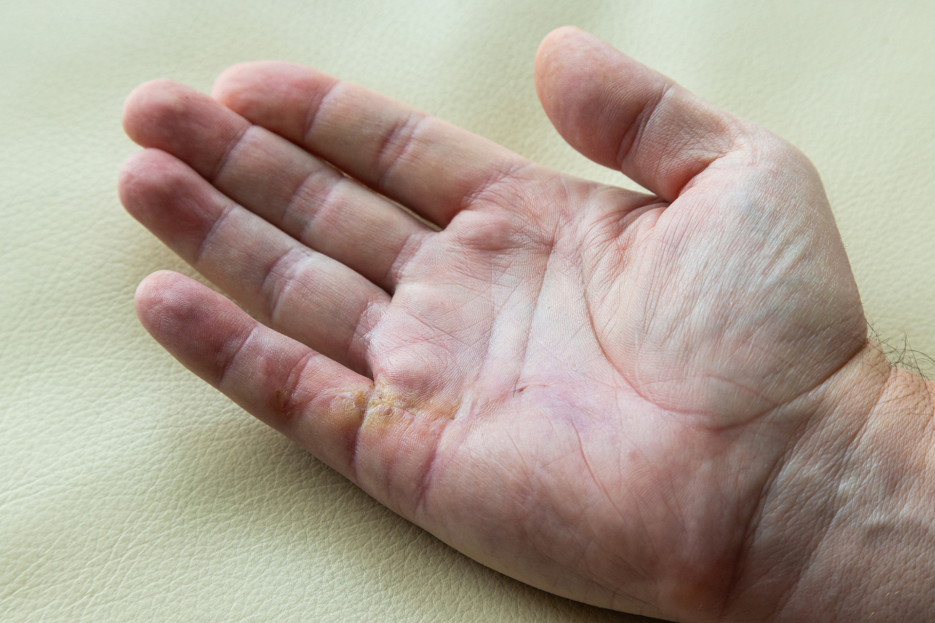 手部的3个异常,占1个以上,劝你查查肺  1,手指变大  这种状况通常表现