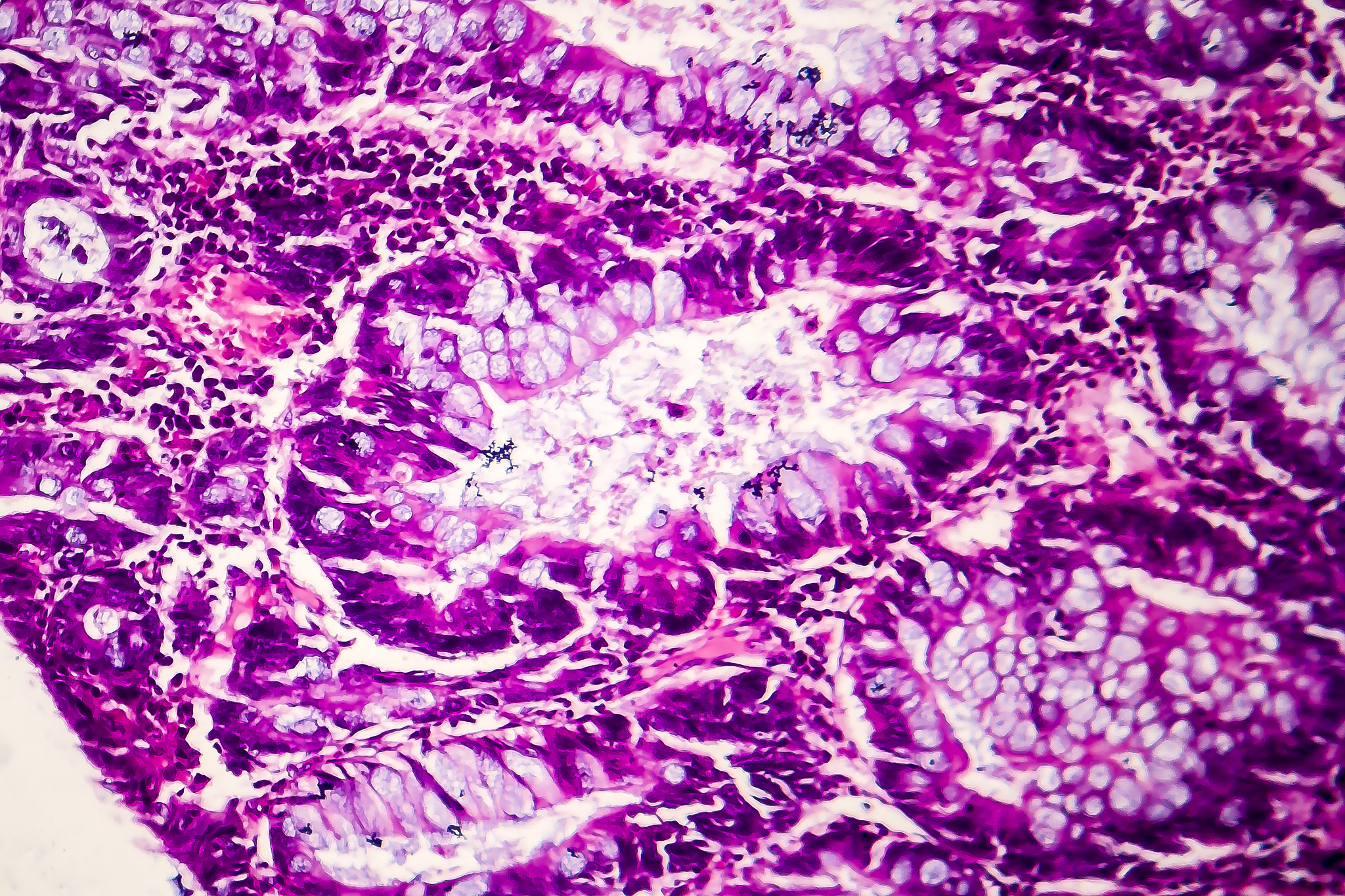 鳞癌是一种起源于鳞状上皮的恶性肿瘤,常常发生在皮肤,口腔,食管,宫颈