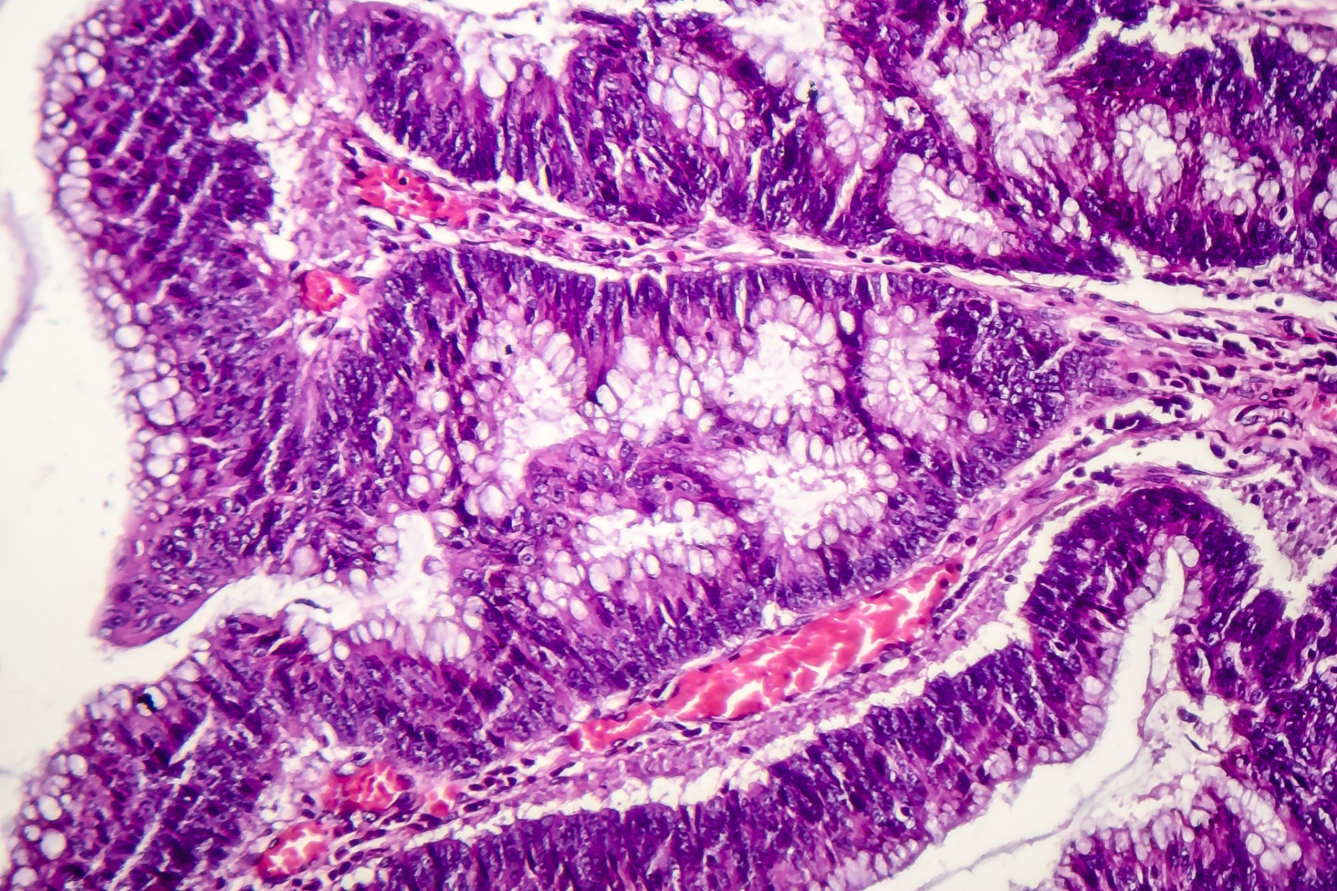 王先生在2021年发现肠上皮化生,当时是轻度,因为没有特别的症状,医生
