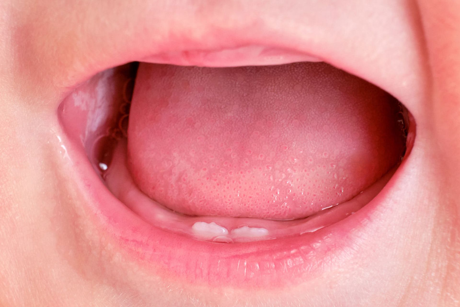 舌系带是连接舌头底部和下颚骨的组织结构,它在人体的语音,呼吸,进食