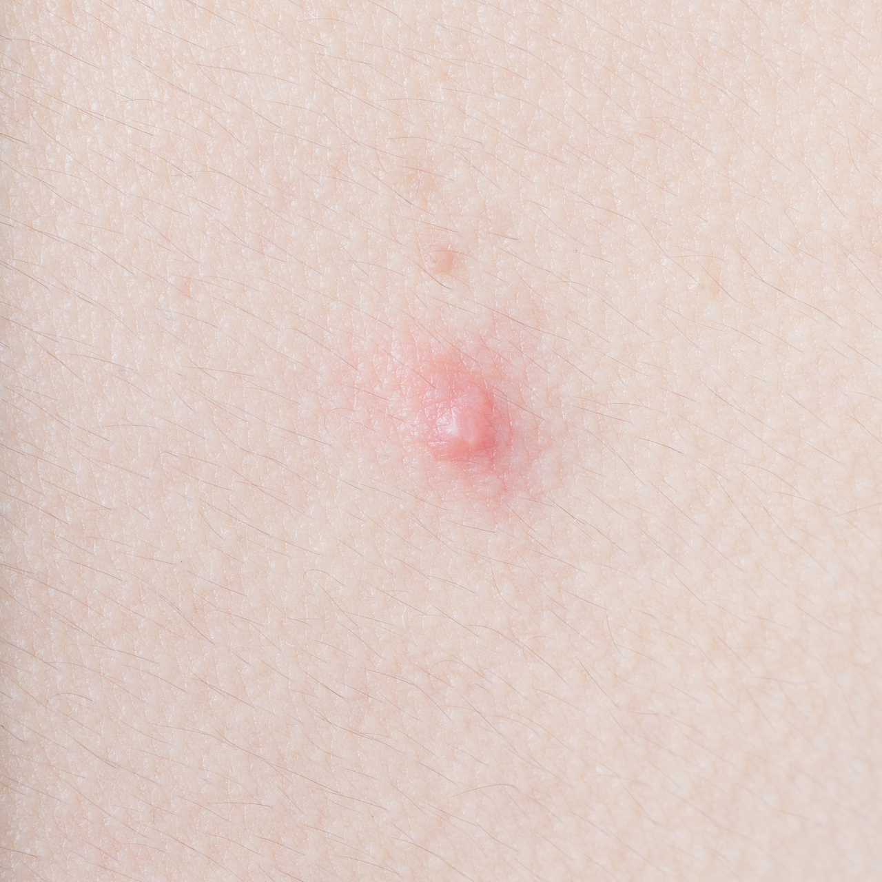 毛囊炎有很多类型,临床上比较多见的是细菌性的毛囊炎,引起它发病的致