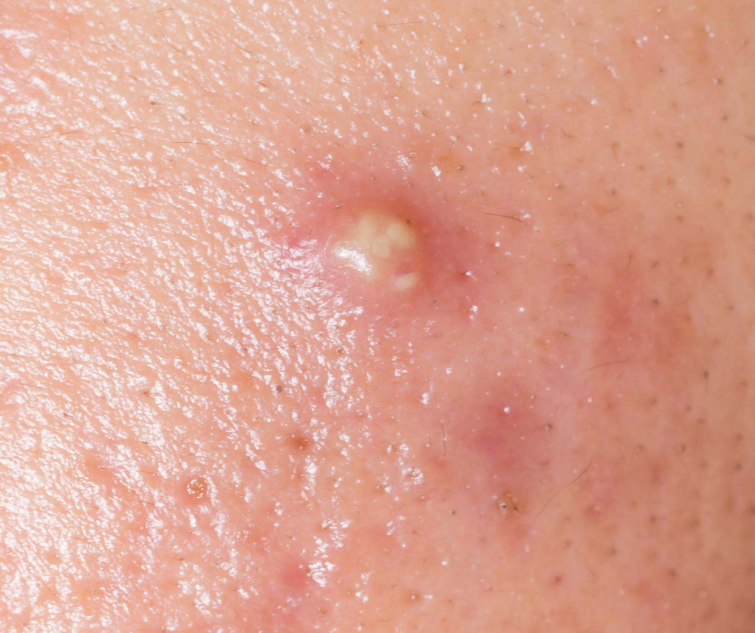 过度挤压或处理不当会导致感染扩散,加重痘痘问题