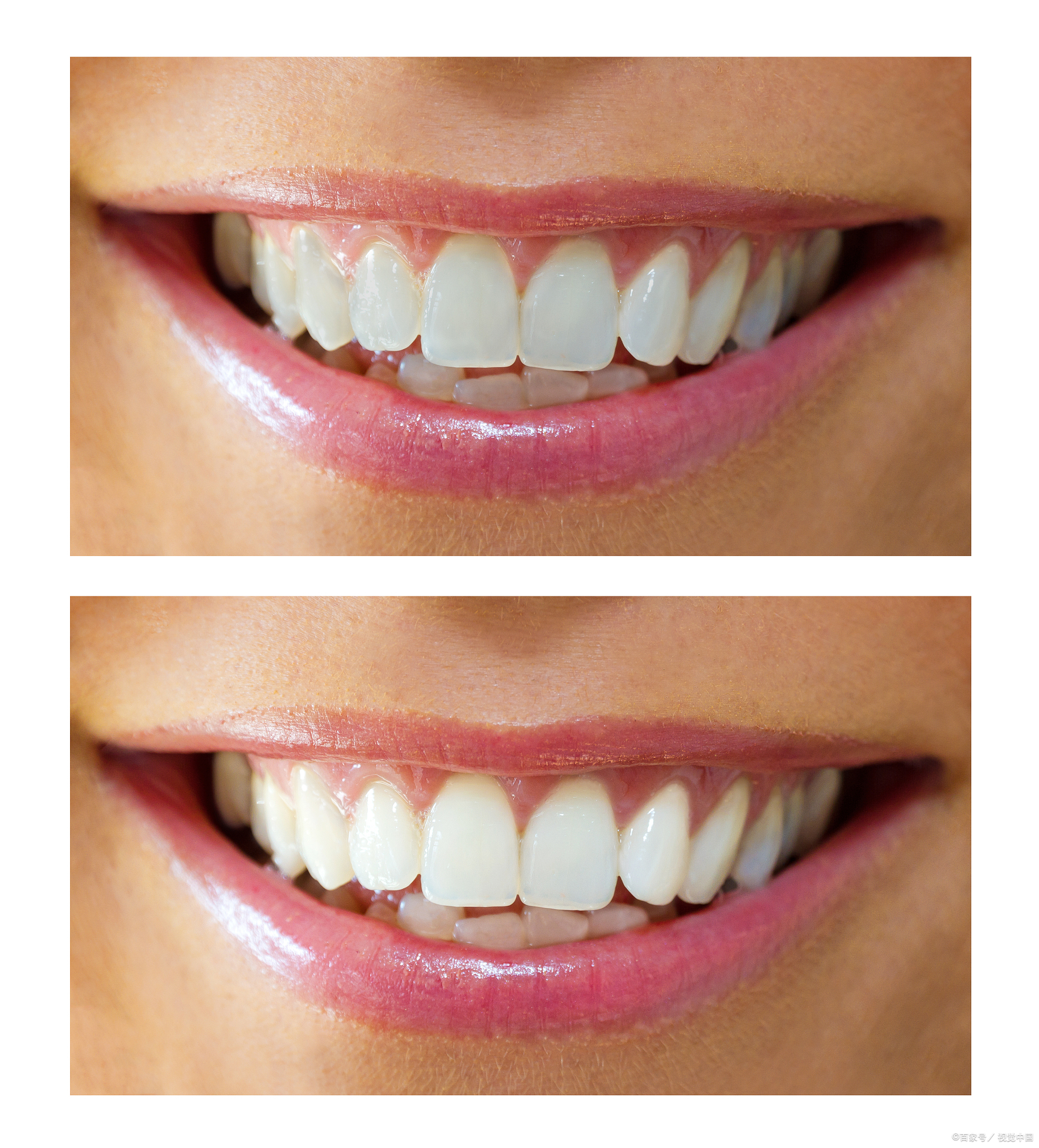 冷光美白牙齿效果可以维持多久 .@花花爱美美的动态