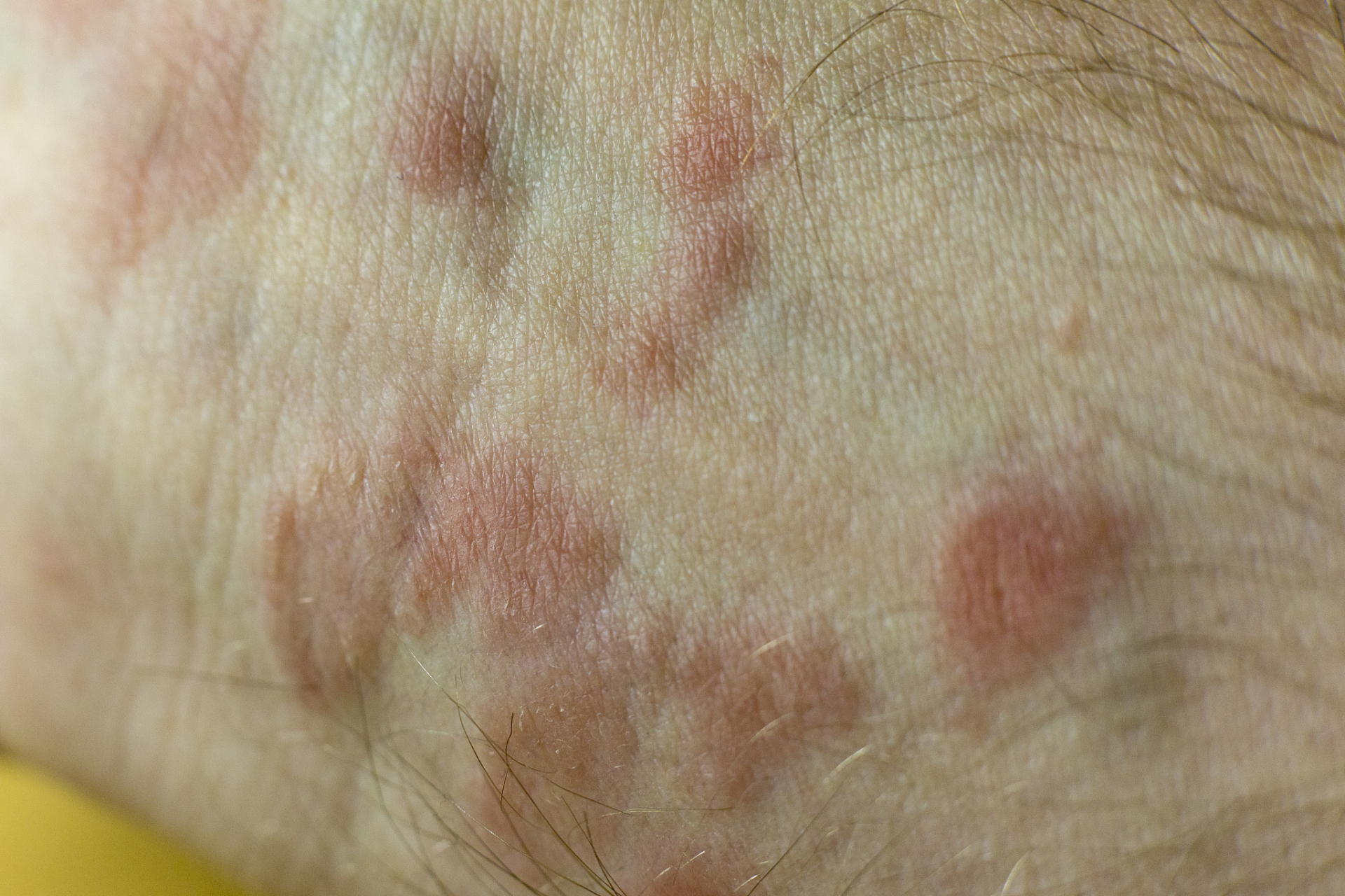 硬下疳是原发梅毒的典型症状,多数梅毒患者会出现硬下疳,但先天性梅毒