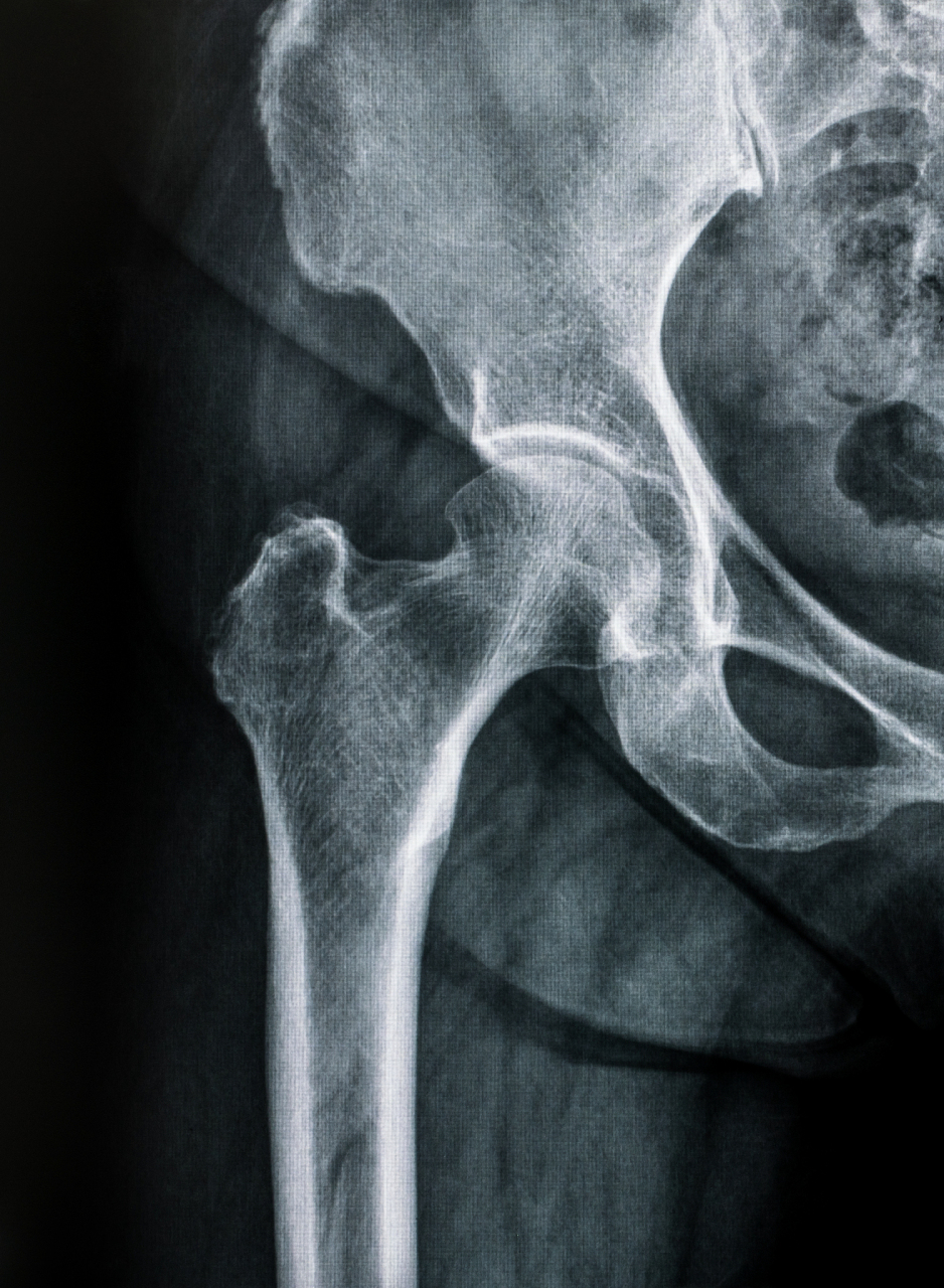 尾骨骨折十天可以正常行走吗?