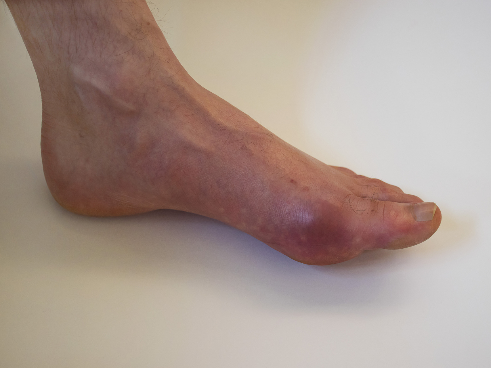 3%,患病人群约1.77亿,痛风总体发病率为1.1%,患病人数约为1466万.