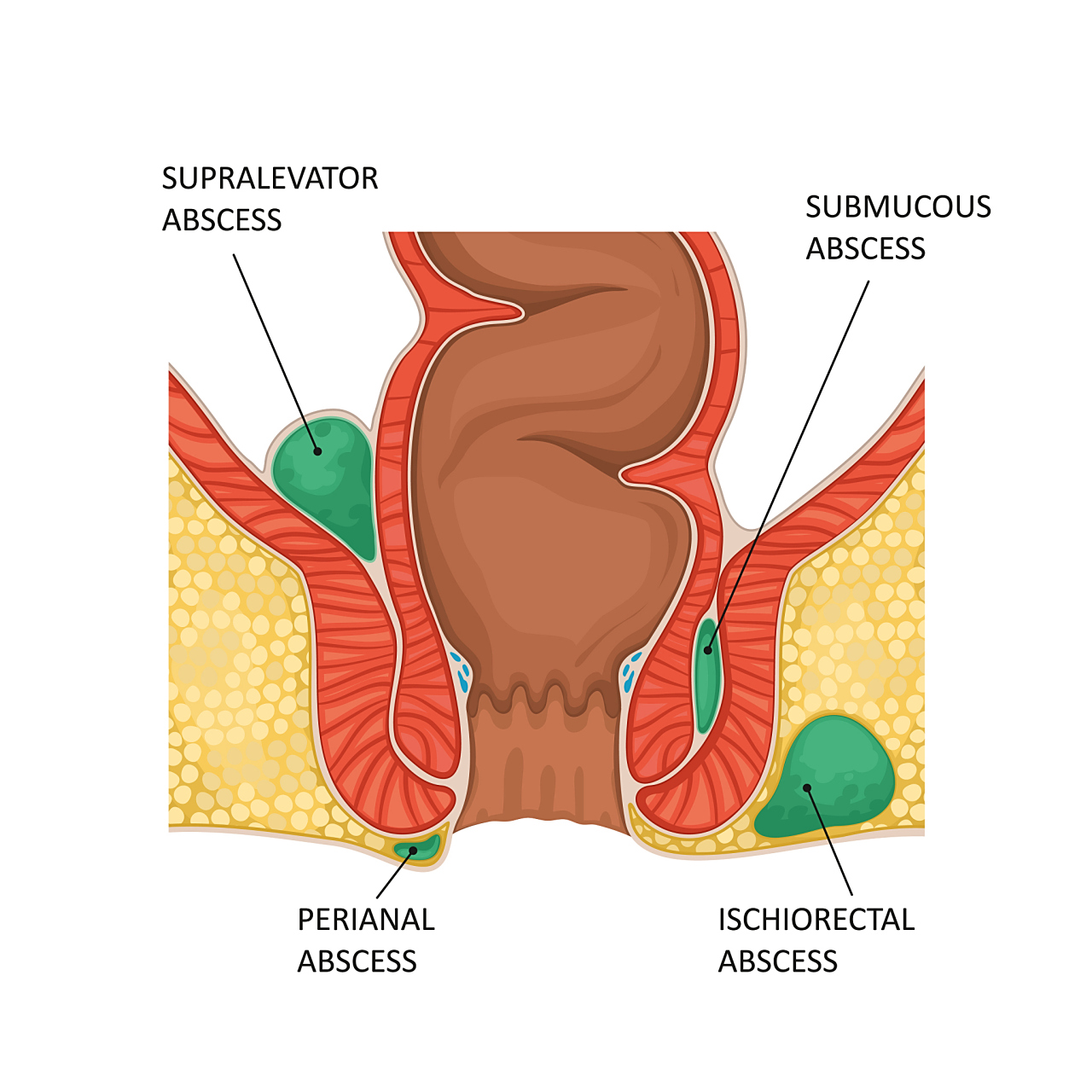 97肛窦炎是一种常见的肛门疾病,它是由于肛门周围